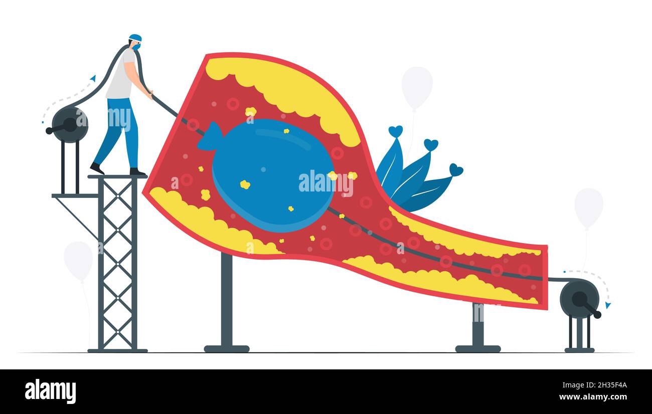Cette maladie est le rétrécissement des artères coronaires.L'angioplastie par ballonnet permet d'améliorer le flux sanguin des vaisseaux.Illustration du vecteur cardiologique. Illustration de Vecteur