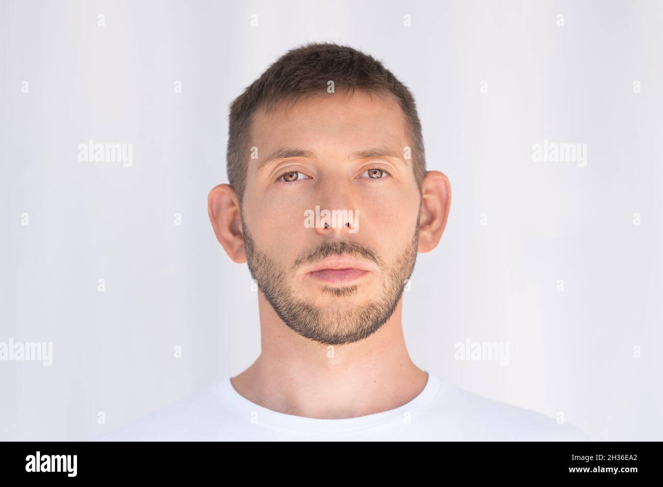 Homme à l'oreille, grandes oreilles.Défaut des oreilles.Patient avant la chirurgie plastique.En attente d'otoplastie Banque D'Images