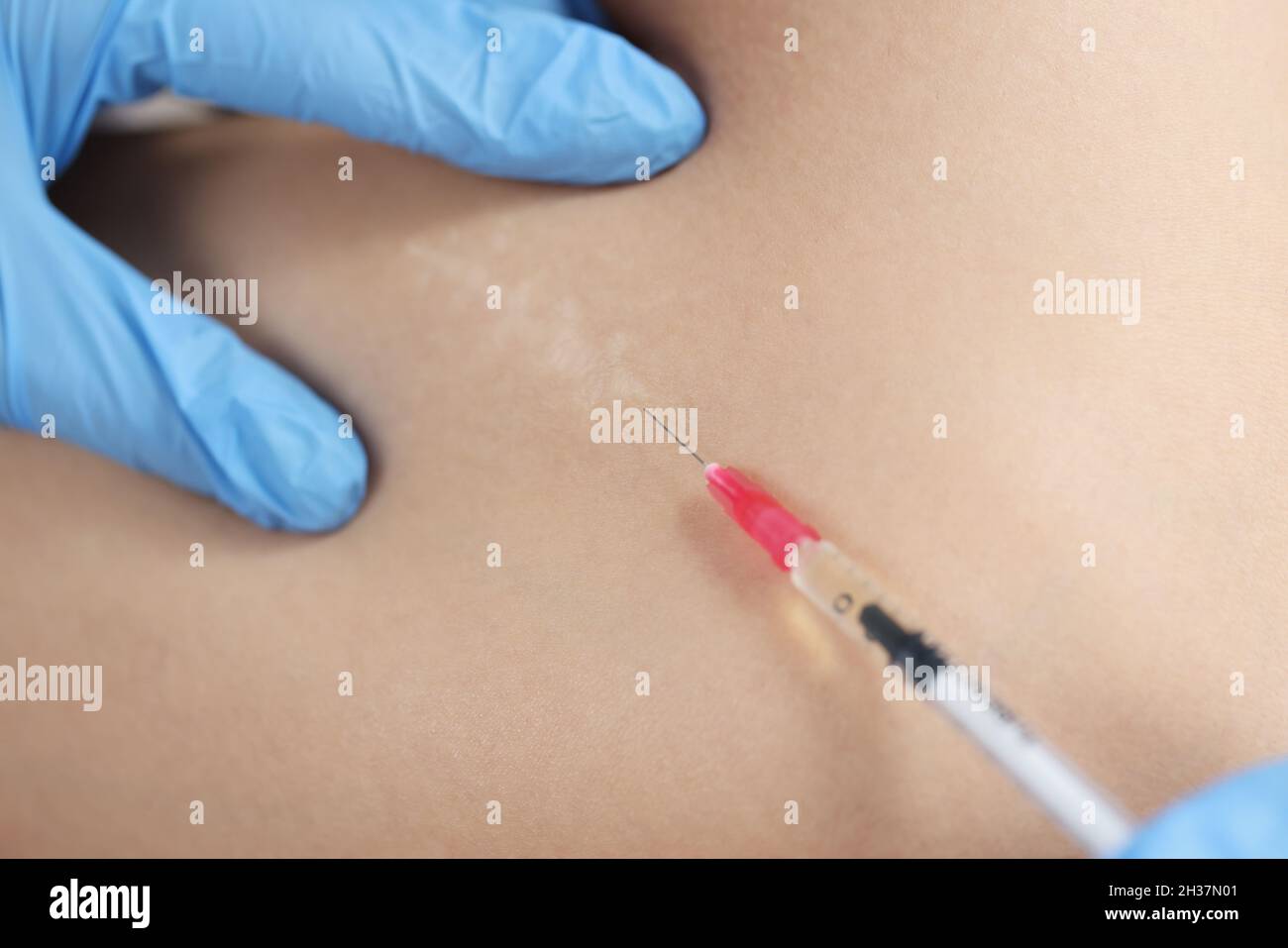 Médecin injectant des médicaments dans la zone de cicatrice postopératoire sur la peau de gros plan Banque D'Images