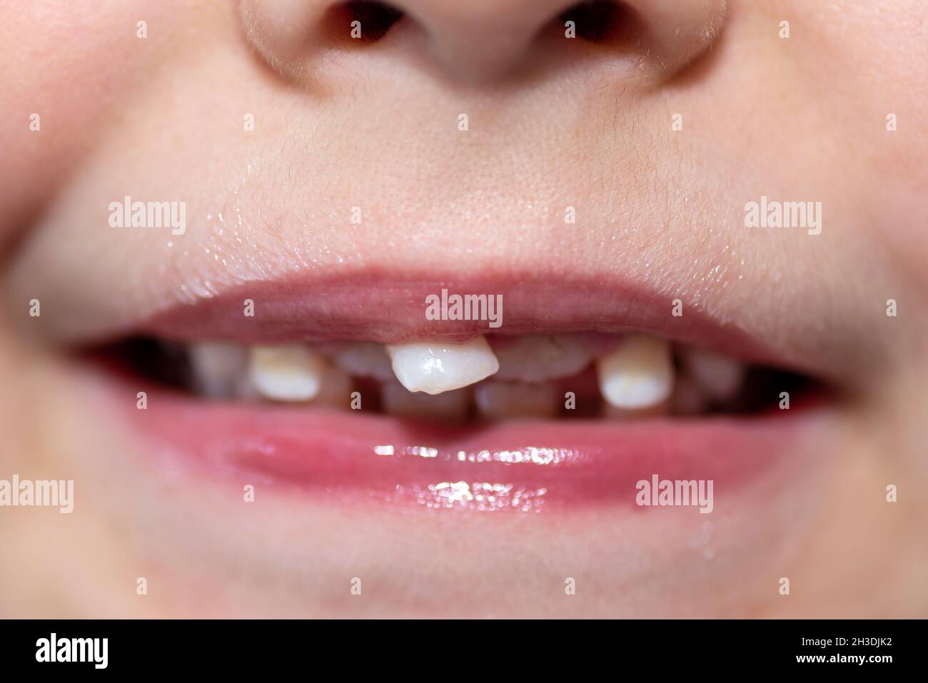 Petit garçon à bouche ouverte montrant des dents de lait à l'avant et des dents permanentes en croissance. Banque D'Images