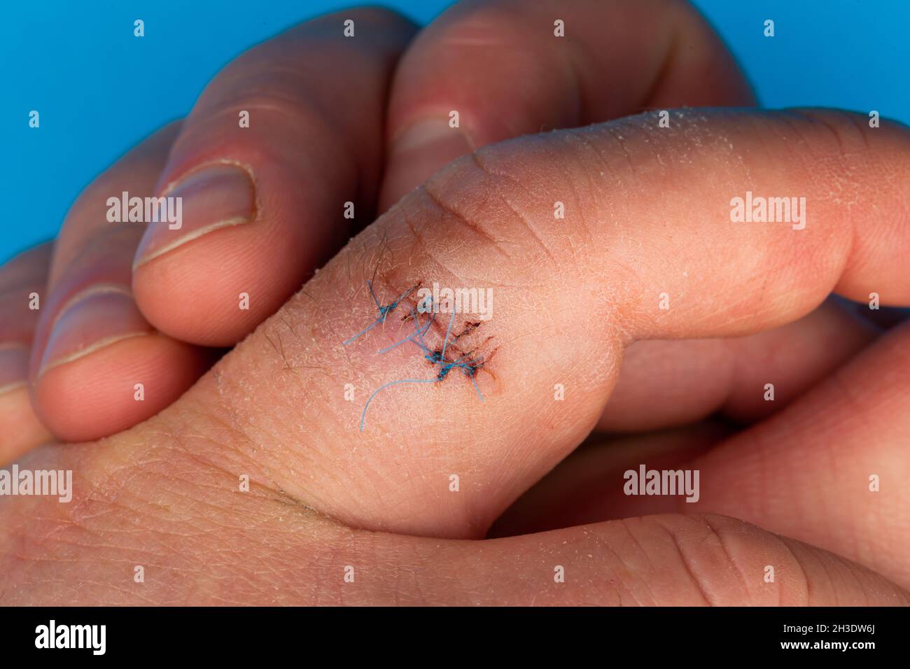 Sutures postopératoires sur le doigt de la main.Points de suture ...