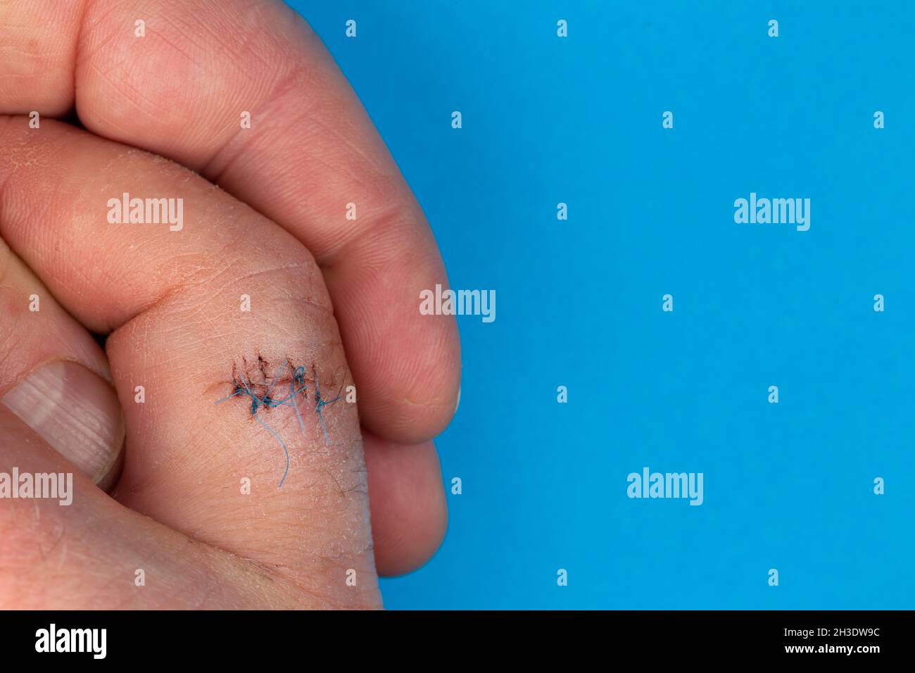 Sutures postopératoires sur le doigt de la main.Points de suture sur le doigt blessé.Photo prise