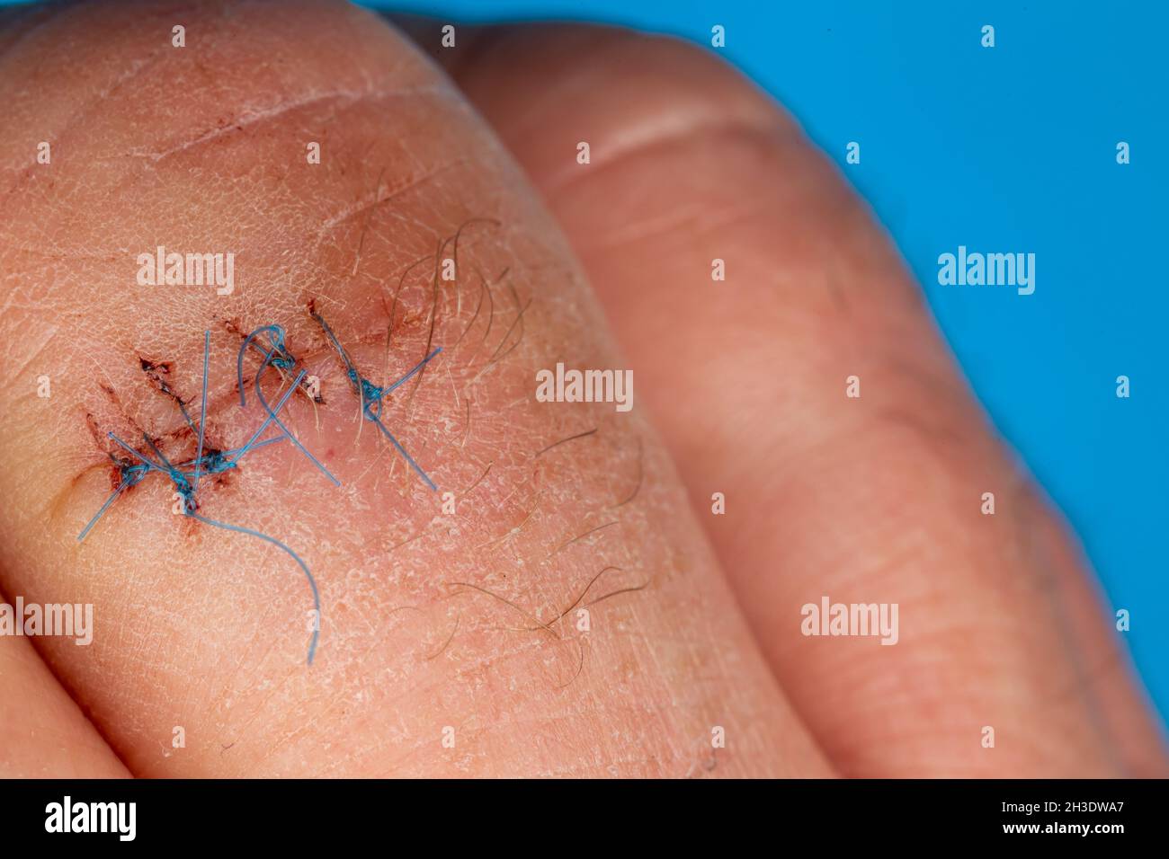 Sutures postopératoires sur le doigt de la main.Points de suture sur le doigt blessé.Photo prise sous lumière artificielle Banque D'Images