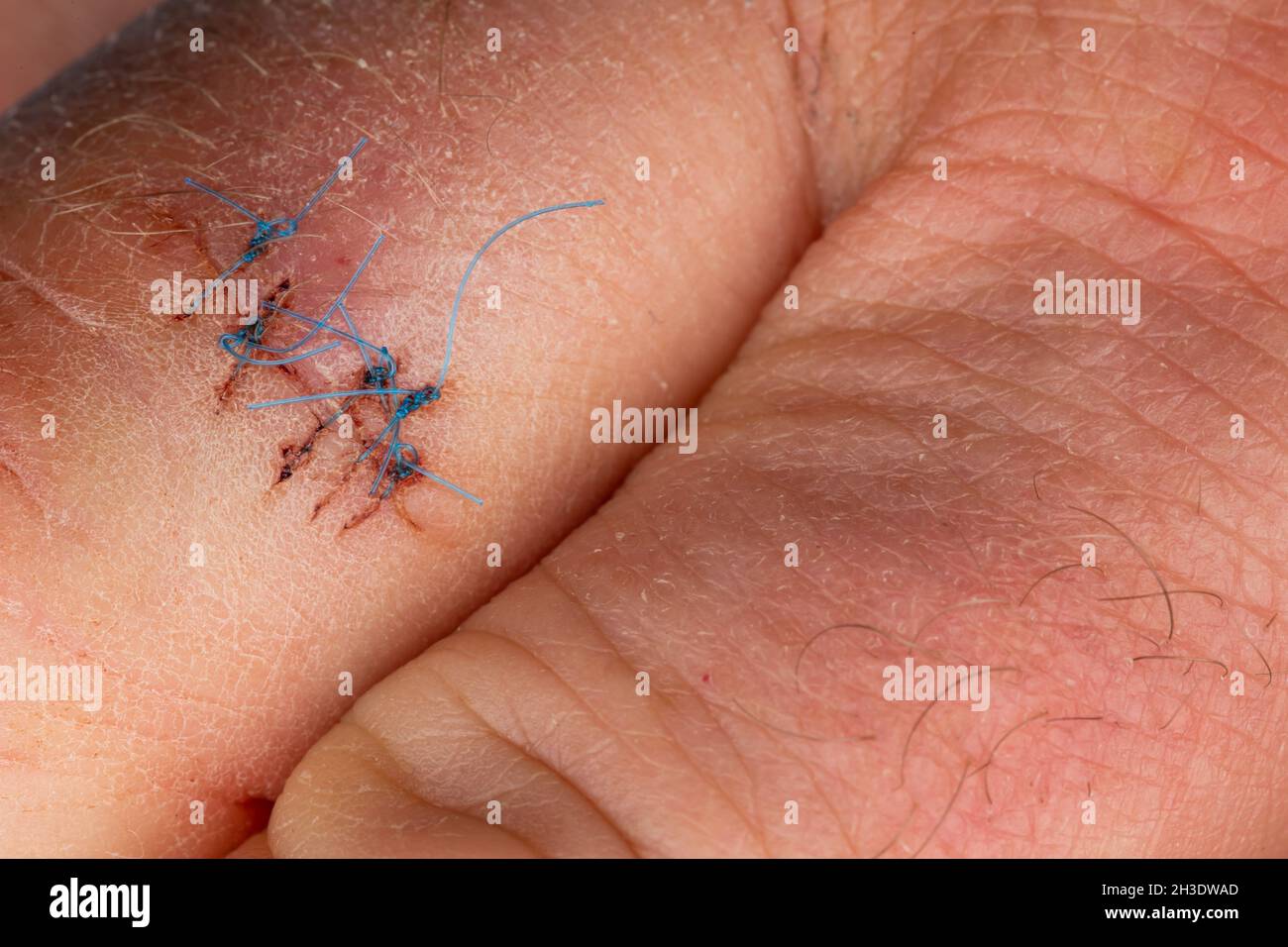 Sutures postopératoires sur le doigt de la main.Points de suture sur le doigt blessé.Photo prise sous lumière artificielle Banque D'Images