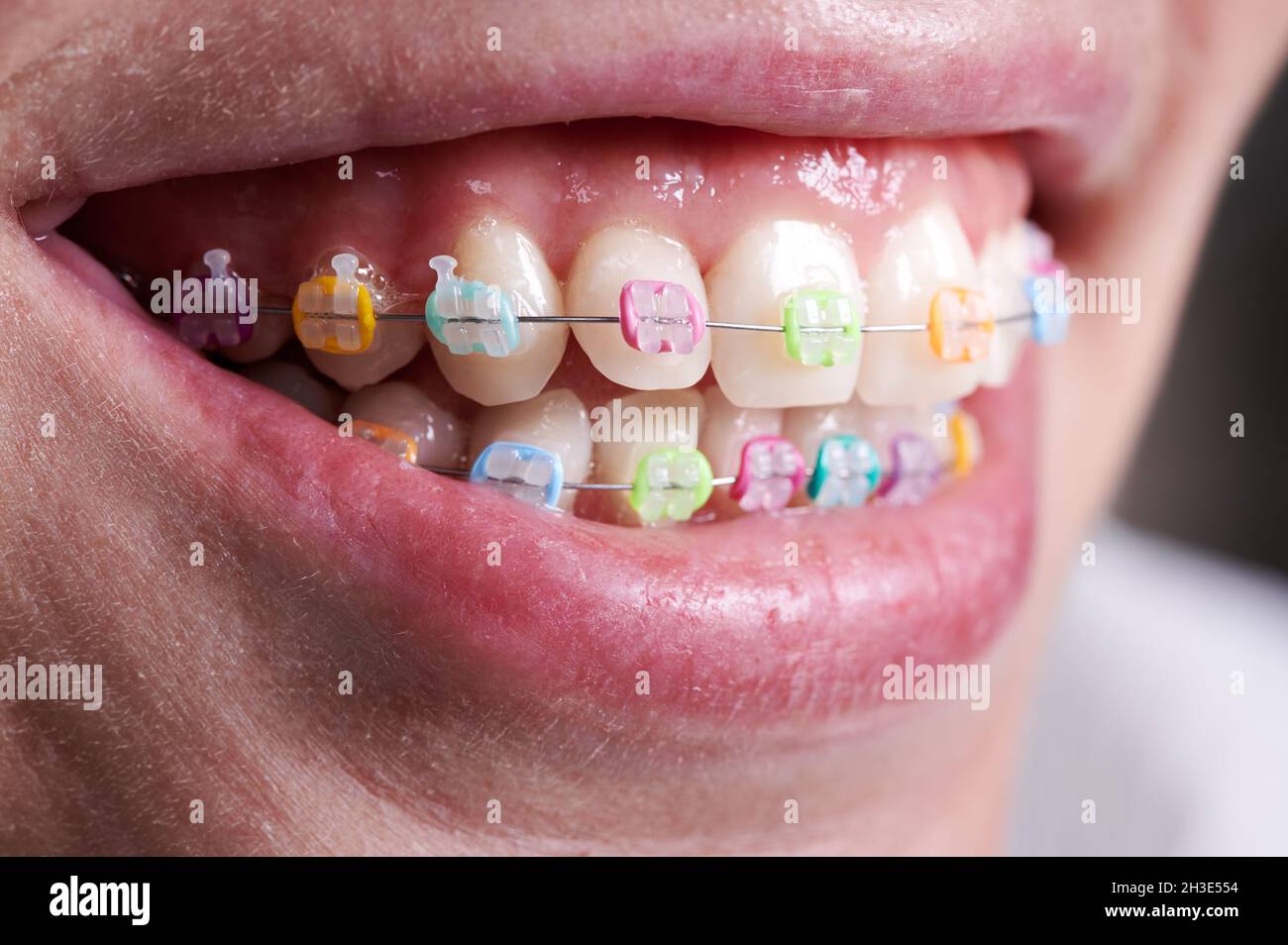 Gros plan d'appareils orthodontiques avec joints toriques colorés sur les dents.Femme patiente présentant des supports dentaires avec des bandes en caoutchouc multicolores.Concept de la dentisterie, de l'orthodontie et de la stomatologie. Banque D'Images