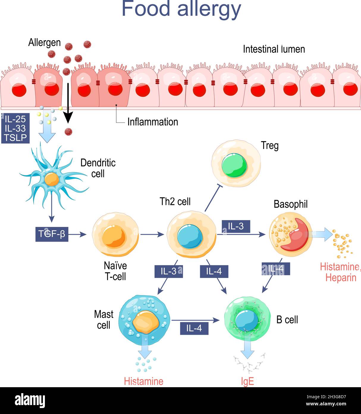 Allergie alimentaire.Inflammation de l'intestin.Allergènes, histamine et cellules immunitaires, qui libèrent la réaction allergique. Illustration de Vecteur