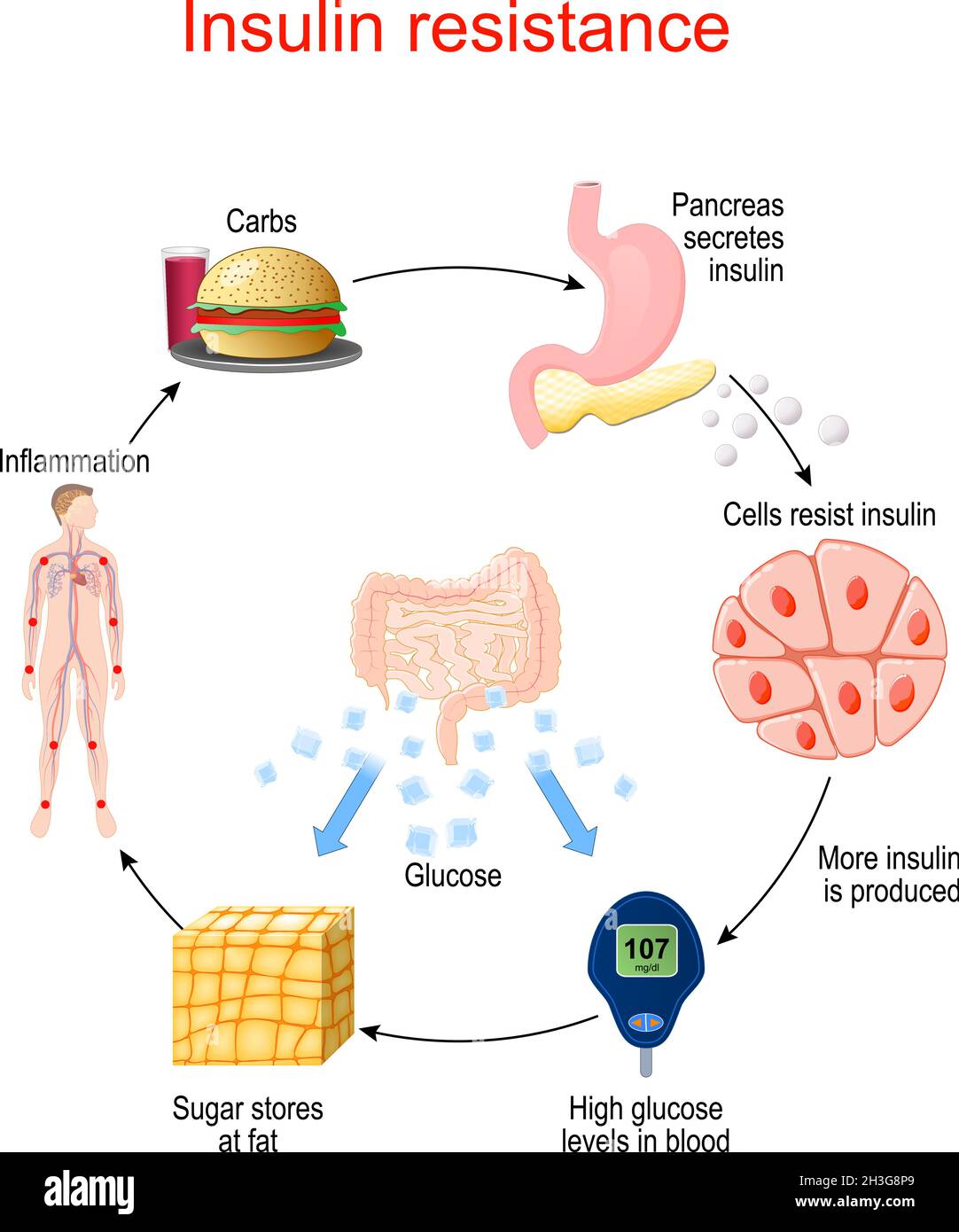 Résistance à l'insuline. État pathologique dans lequel les cellules ne répondent pas normalement à l'insuline hormonale.Cycle de l'insuline et du glucose. Illustration de Vecteur