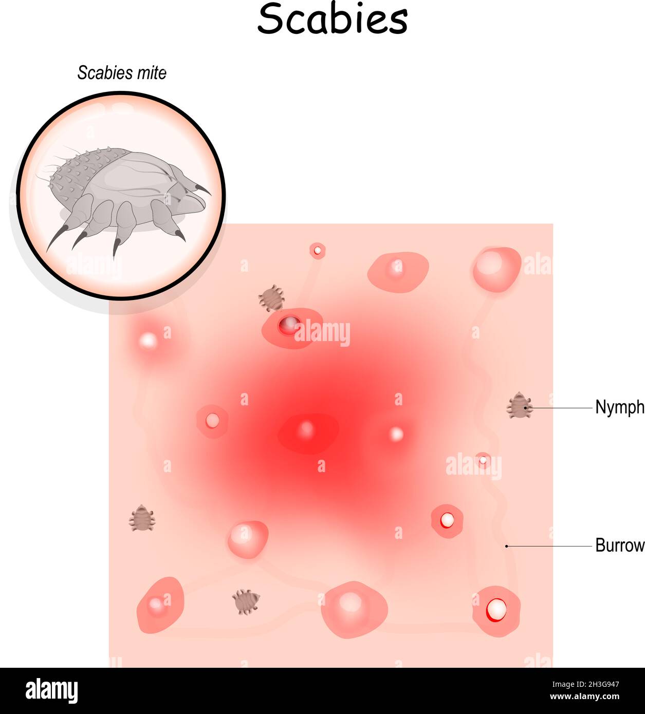 Gale. Infestation contagieuse de la peau.Gros plan de l'acarien de la gale et de la peau de l'homme avec vue agrandie d'un sentier de terriers de l'acarien. Illustration de Vecteur