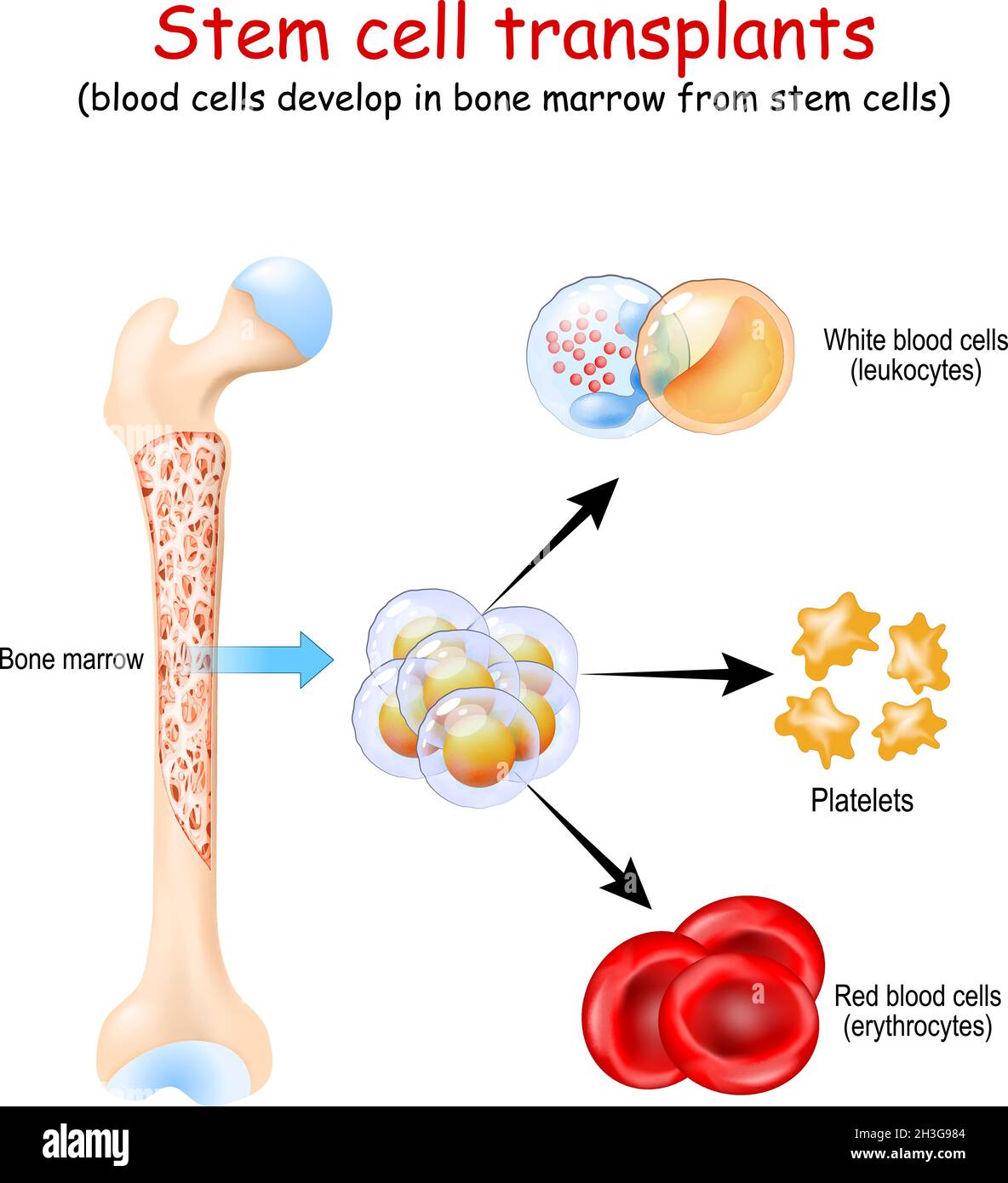 Transplantations de cellules souches. Les cellules sanguines se développent dans la moelle osseuse à partir de cellules souches. Érythrocytes, leucocytes et plaquettes Illustration de Vecteur