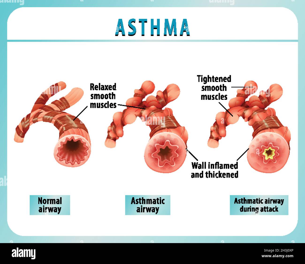 Schéma de l'asthme bronchique avec illustration des voies aériennes normales et des voies respiratoires asthmatiques Illustration de Vecteur