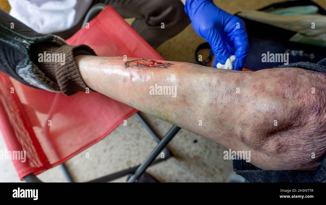 blessure transformée en ulcère variqueux sur une jambe qui doit être guérie quotidiennement Banque D'Images
