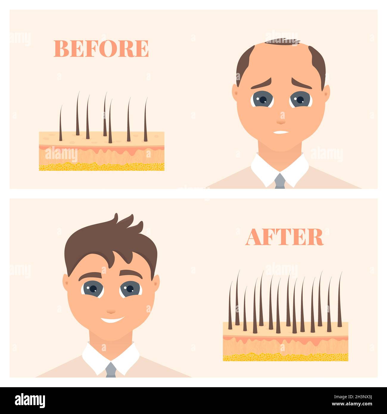 Traitement de l'alopécie, illustration Banque D'Images