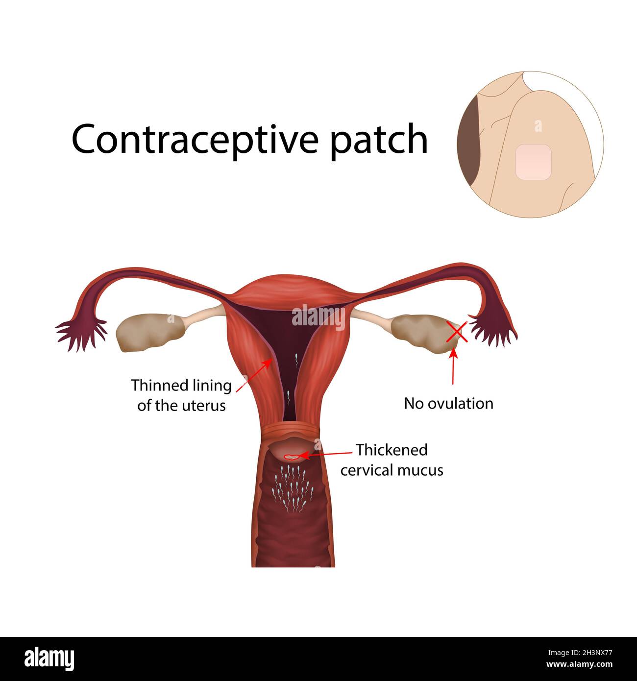 Patch contraceptif, illustration Banque D'Images