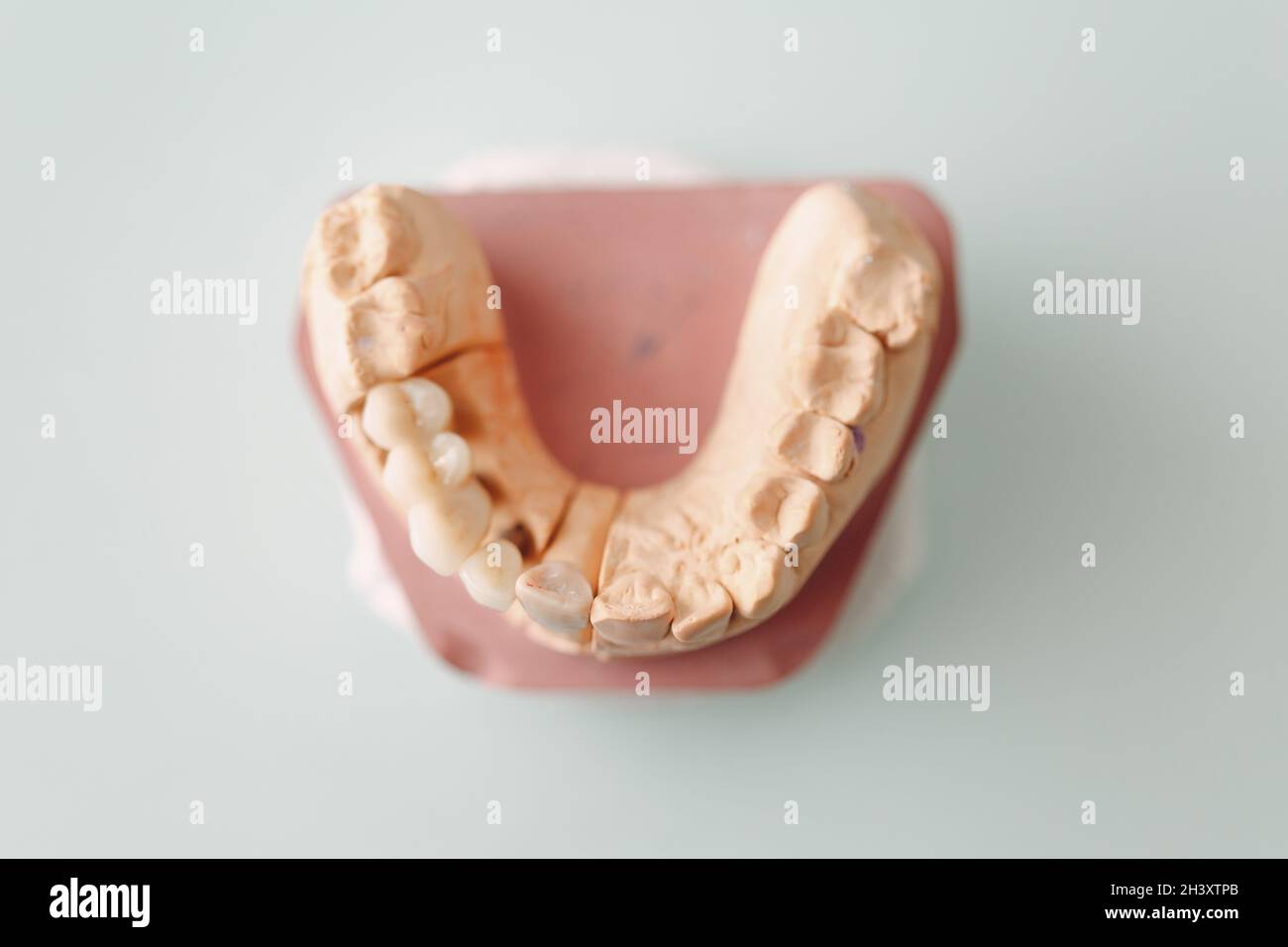 Disposition dentaire de la mâchoire humaine avec dents et implants. Banque D'Images