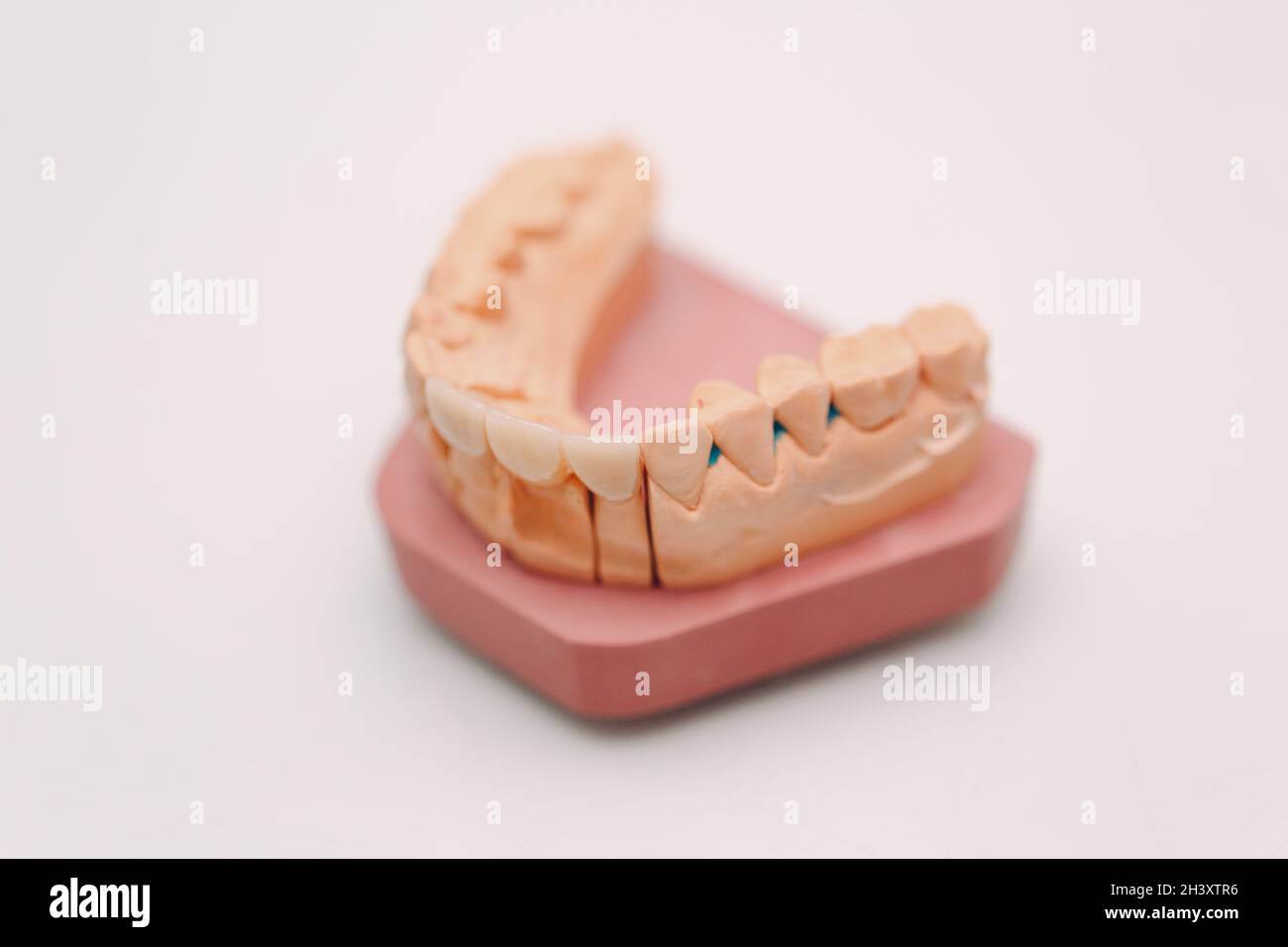 Disposition dentaire de la mâchoire humaine avec dents et implants. Banque D'Images