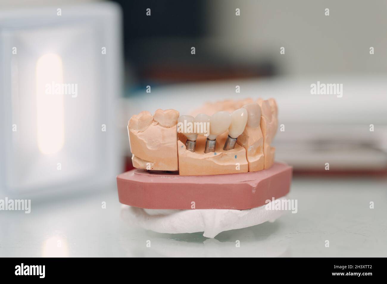 Disposition dentaire de la mâchoire humaine avec dents et implants. Banque D'Images