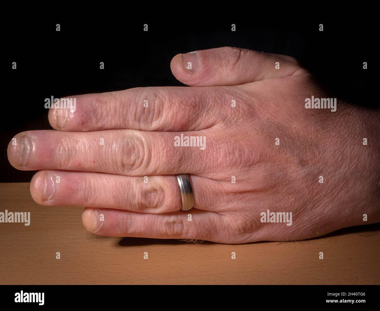 Main caucasienne humaine avec un anneau de mariage montrant des signes de morsure d'ongle, autophagie contre un fond noir Banque D'Images