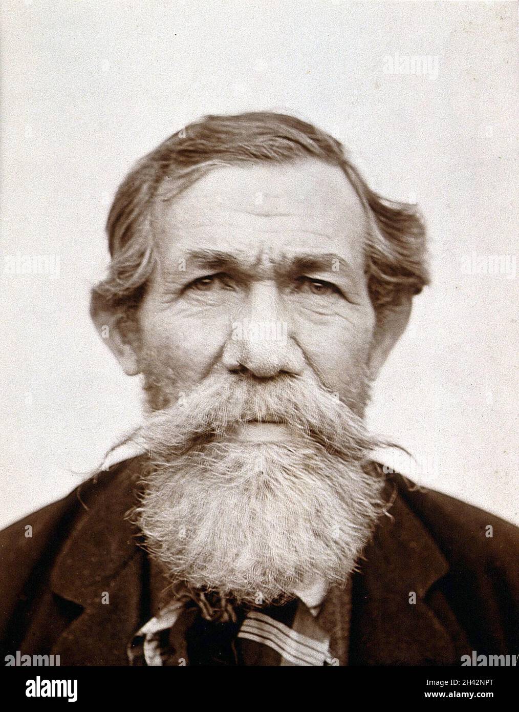 Un patient de Léon Desguin, après opération.Photographie. Banque D'Images