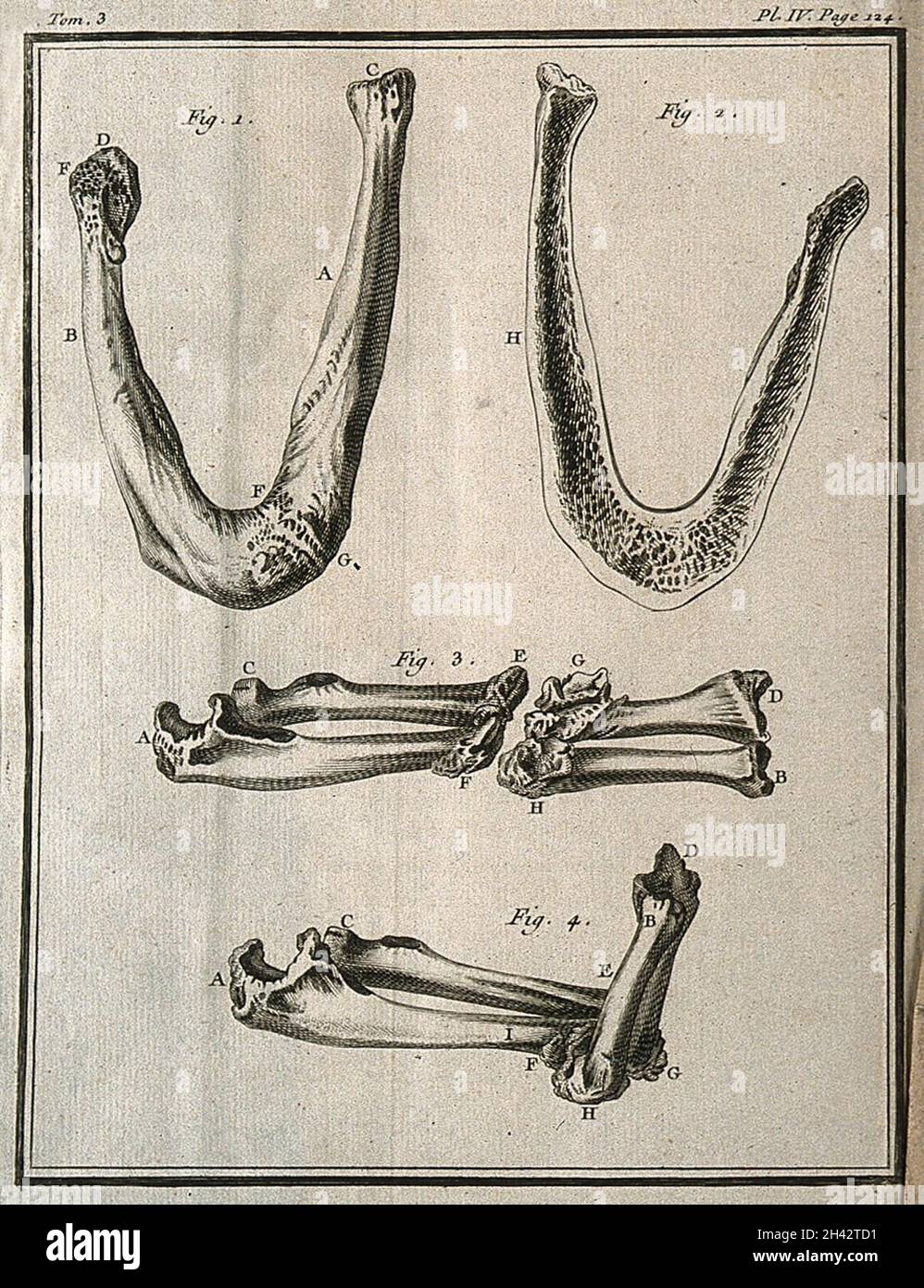 Ankylose des os du fémur droit fracturé (os de la cuisse) et du tibia (os de la jambe inférieure) (figures 1-2) et du rayon et de la cubitus (os de l'avant-bras) reliés par un callus flexible (figures 3-4) gravure, 1749. Banque D'Images