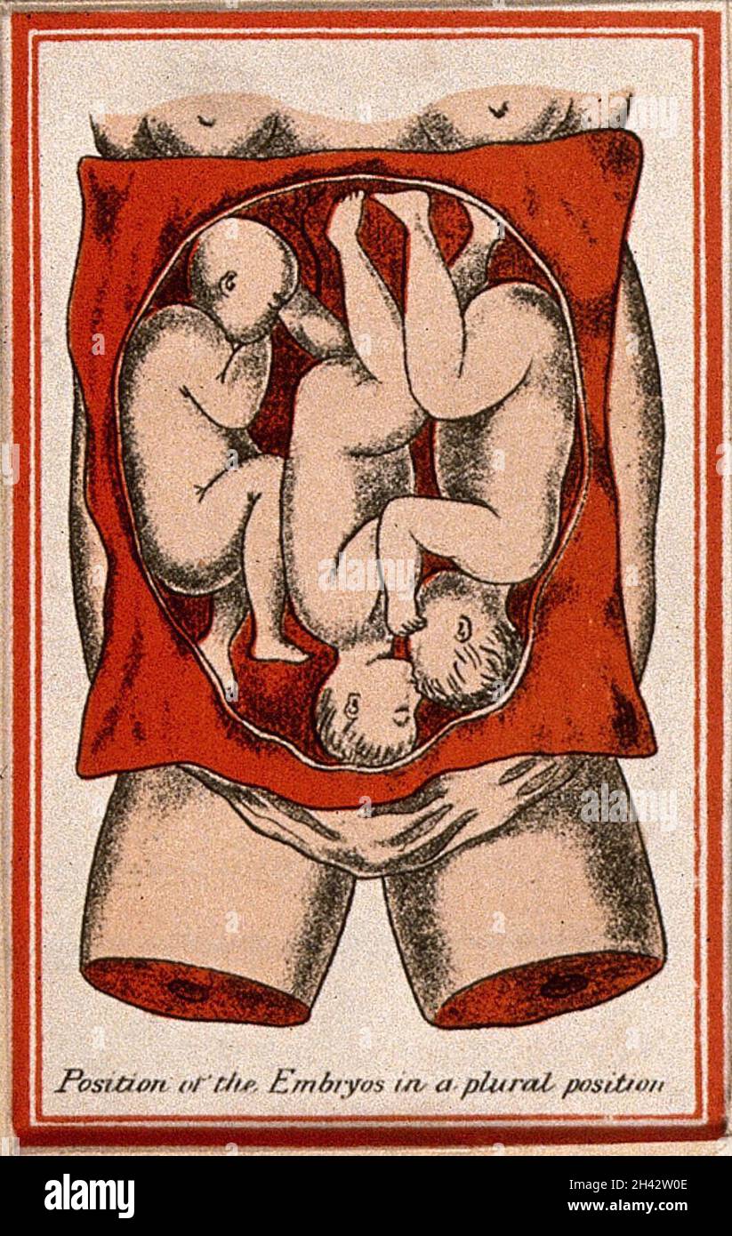 Triplés, représentés dans l'utérus : illustration montrant la position des fœtus dans une position plurale.Lithographie couleur, 1850/1910? Banque D'Images