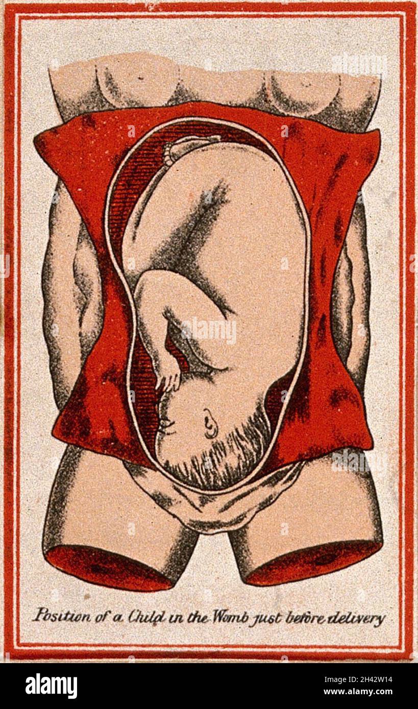 Position D Un Bebe Dans L Uterus Peu Avant La Naissance Lithographie Couleur 1850 1910 Photo Stock Alamy