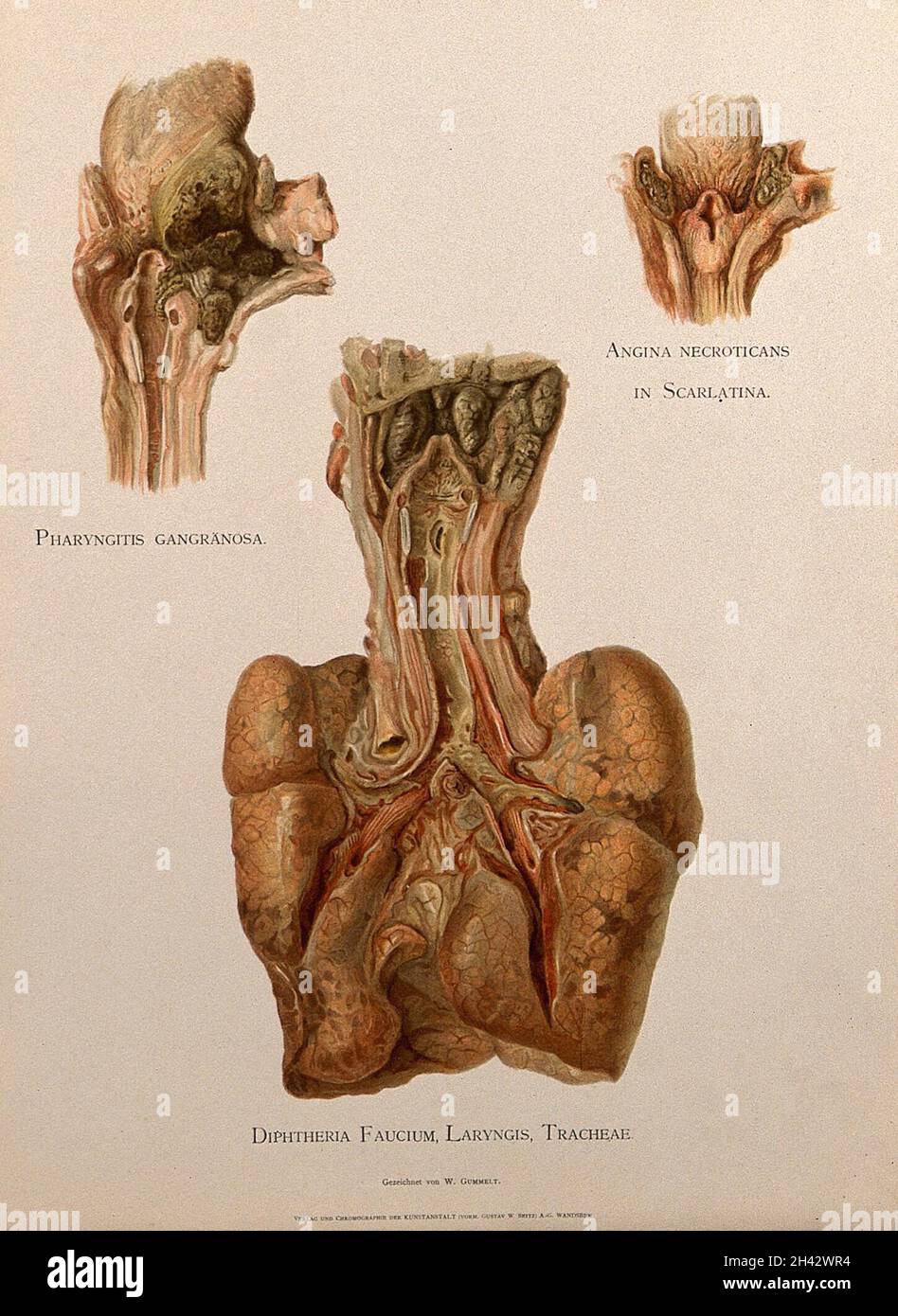 Dissection d'un pharynx, d'un larynx et d'une trachée malades : trois chiffres.Chromolithographe de W. Gummelt, env.1897. Banque D'Images