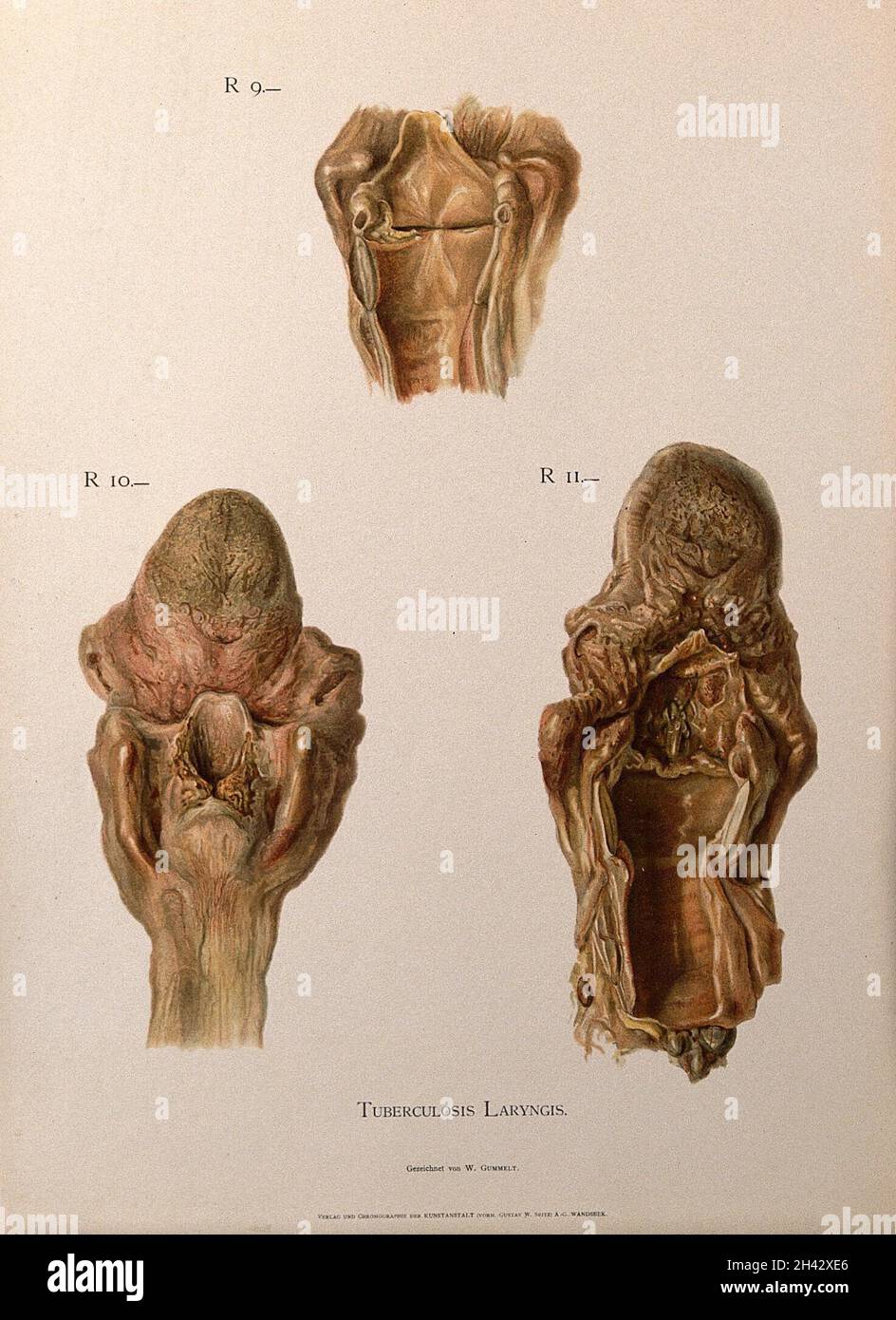 Dissection de larynx malades, affectés par la tuberculose : trois chiffres.Chromolithographe de W. Gummelt, env.1897. Banque D'Images