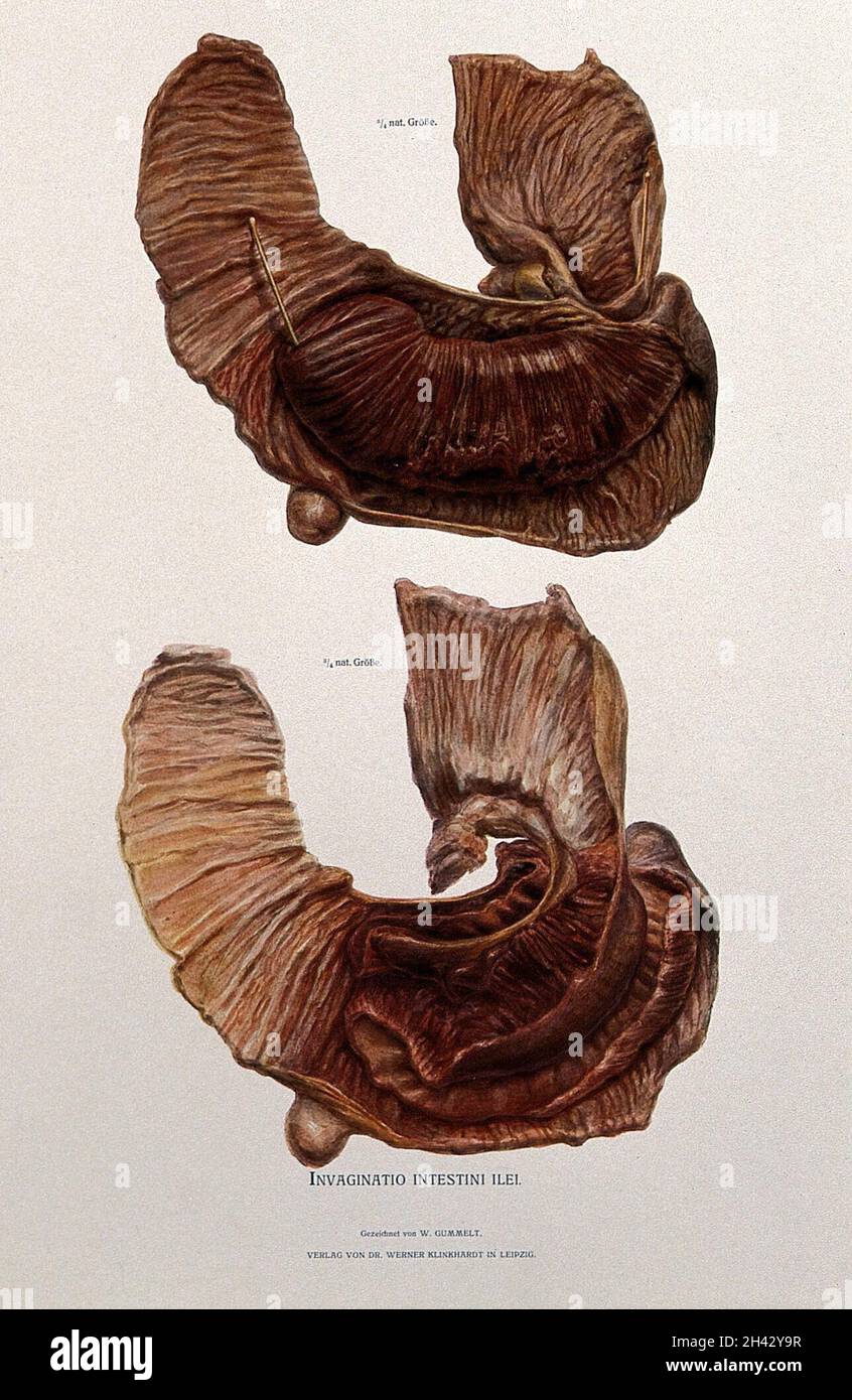 Dissection d'un intestin bouché ou malade : deux chiffres.Chromolithographe de W. Gummelt, env.1897. Banque D'Images