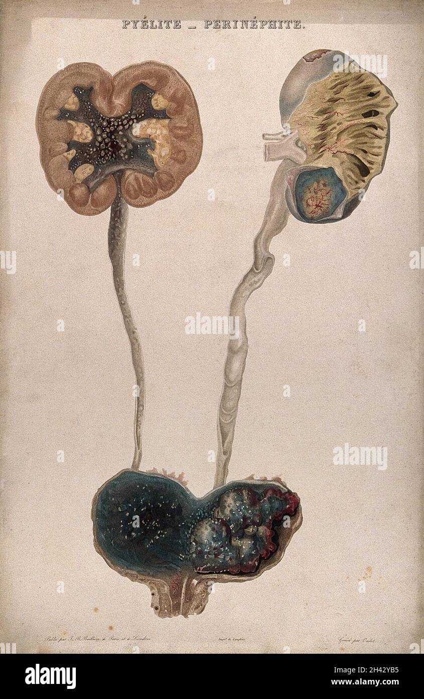 Une maladie provoquant une inflammation des reins et du bassin.Gravure de couleur par Oudet pour payeur. Banque D'Images