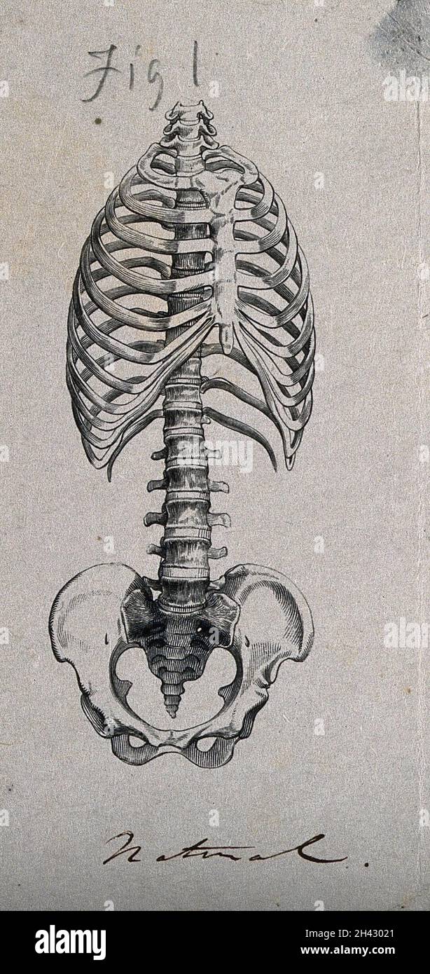 Os de la cage thoracique et du bassin: Deux figures, montrant l'apparence  de la cage thoracique et de la colonne vertébrale dans son état naturel, et  lorsqu'elle est déformée par un laçage