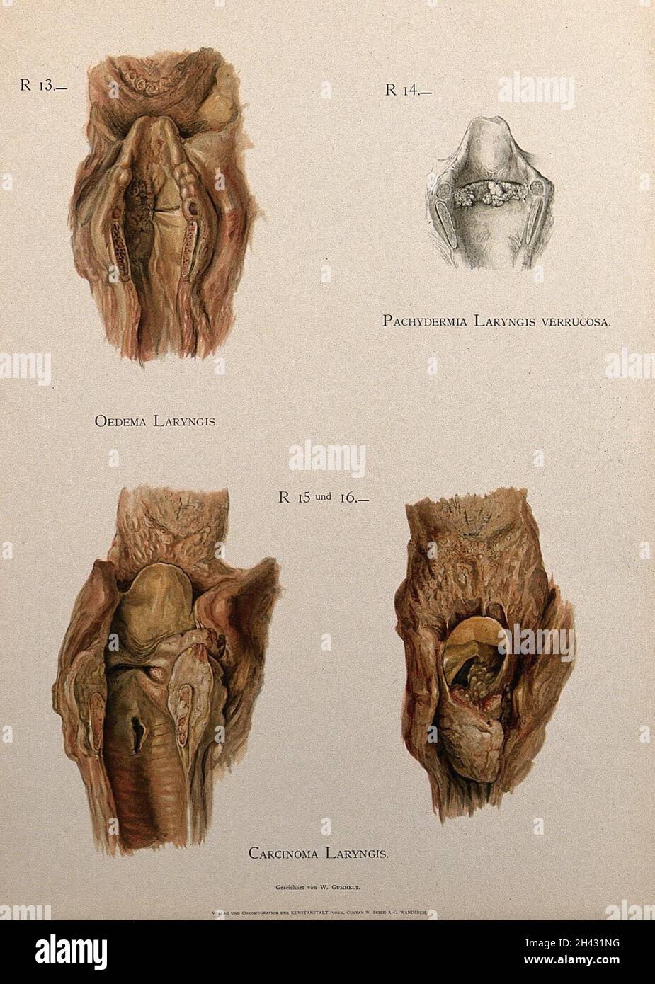 Dissection des larynx affectés par des maladies, y compris le cancer : quatre chiffres.Chromolithographe de W. Gummelt, env.1897. Banque D'Images