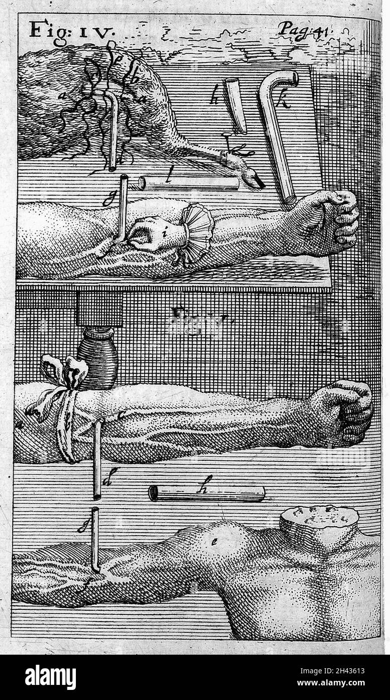 Gravures de techniques de transfusion sanguine d'homme à animal. Banque D'Images