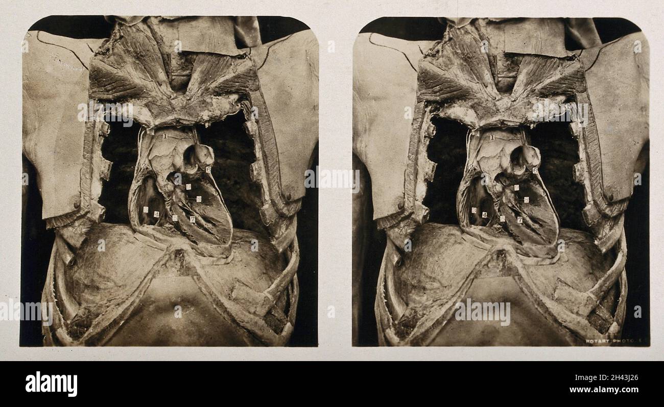 Anatomie : dissection du thorax montrant les cavités ventriculaires du cœur.Photographie, env.1900. Banque D'Images