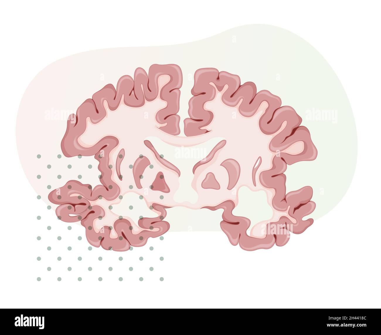 Maladie d'Alzheimer - Section transverse du cerveau - Illustration comme fichier EPS 10 Illustration de Vecteur