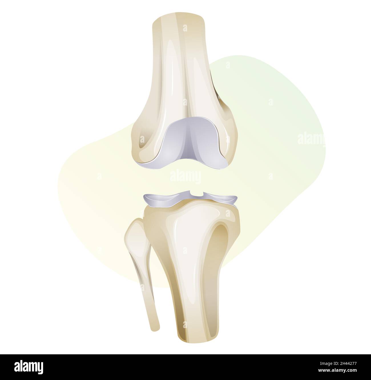 Lésion du cartilage du genou - Illustration comme fichier EPS 10 Illustration de Vecteur