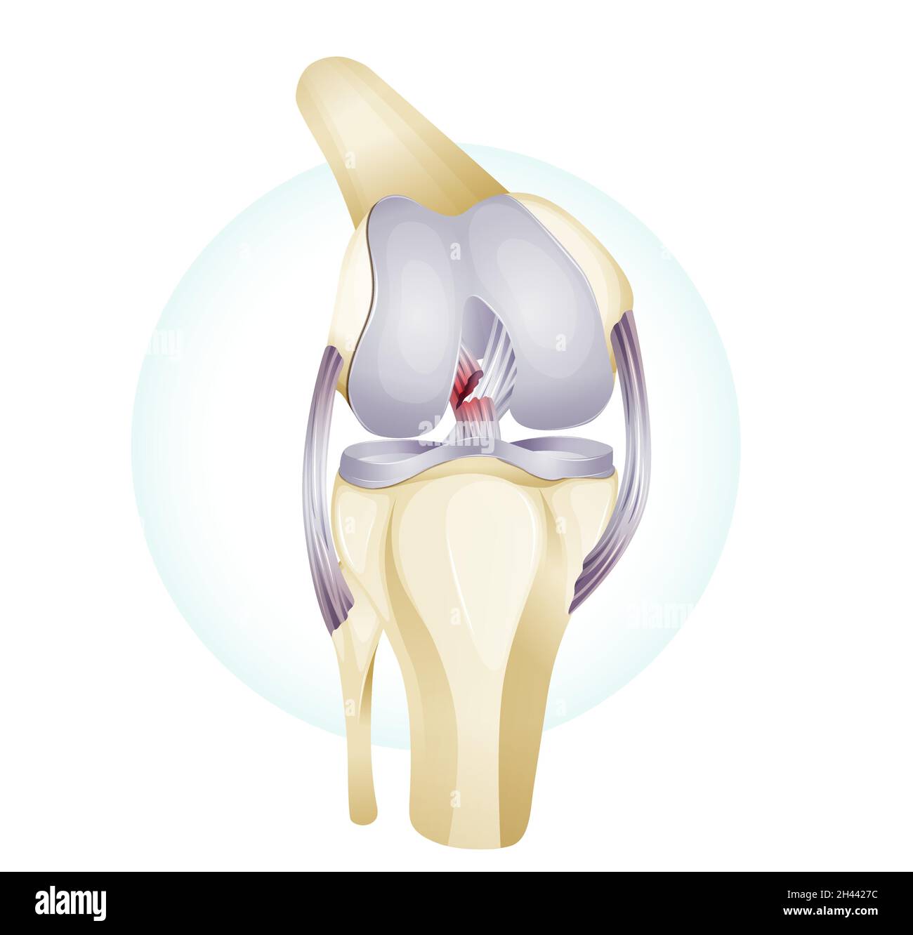 Lésion du cartilage du genou - Illustration comme fichier EPS 10 Illustration de Vecteur