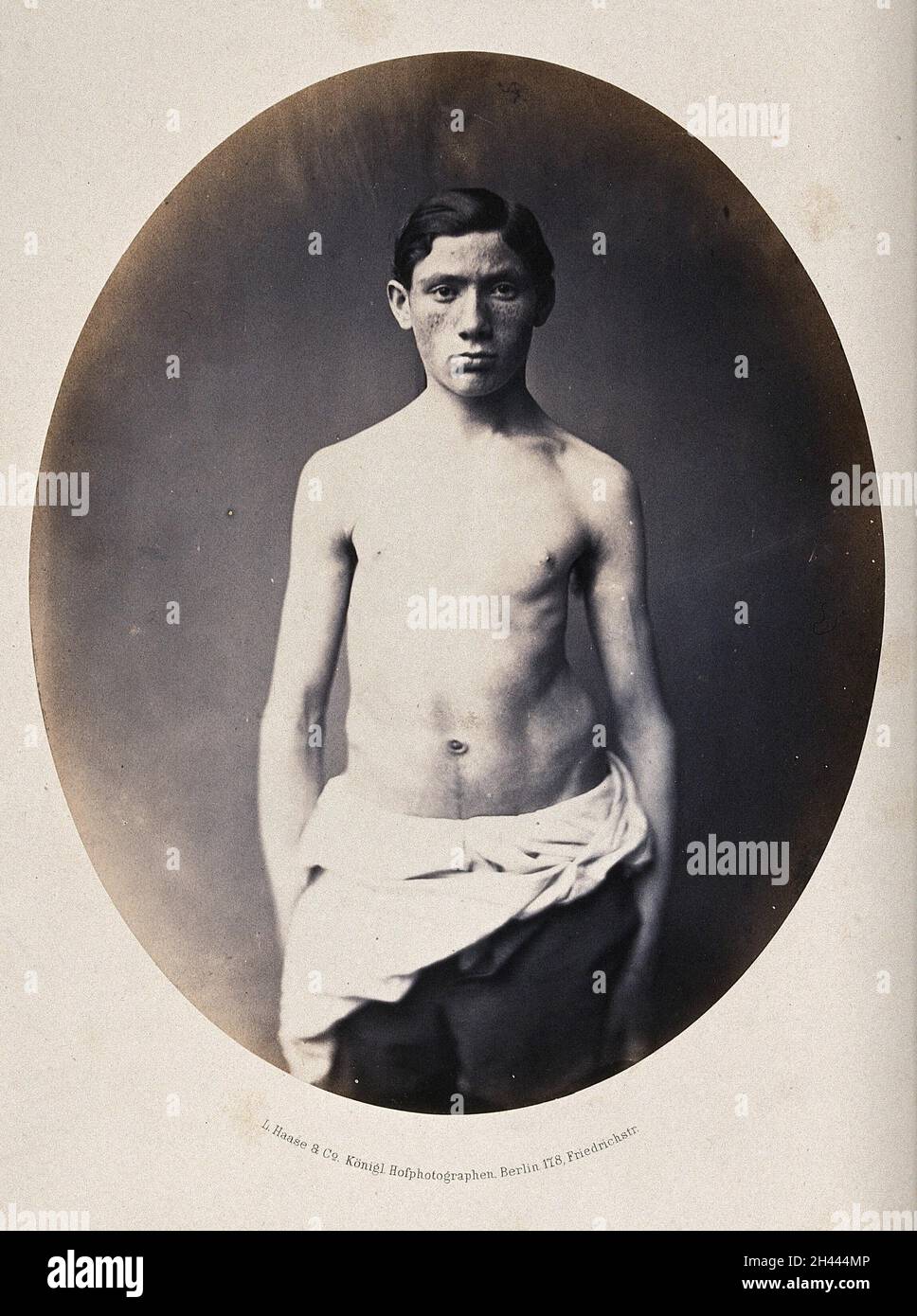 Un jeune homme debout, vue en longueur de 3/4, partiellement vêtu; montrant une déformation de la hanche gauche.Photographie de L. Haase après H.W.Berend, c.1865. Banque D'Images