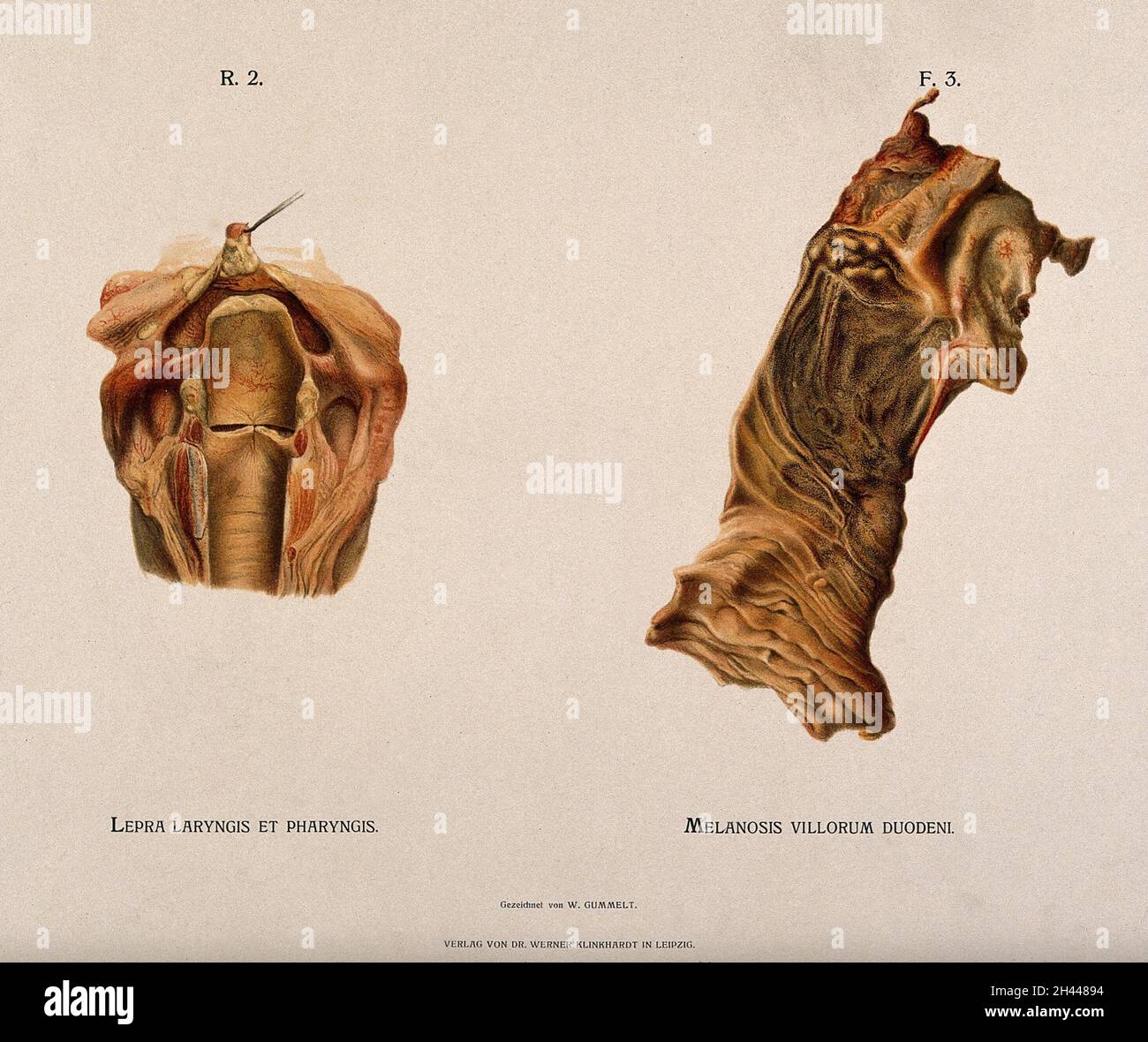 Dissection d'un laylynx et d'un pharynx malades et d'une partie du duodénum : deux figures.Chromolithographe de W. Gummelt, env.1897. Banque D'Images