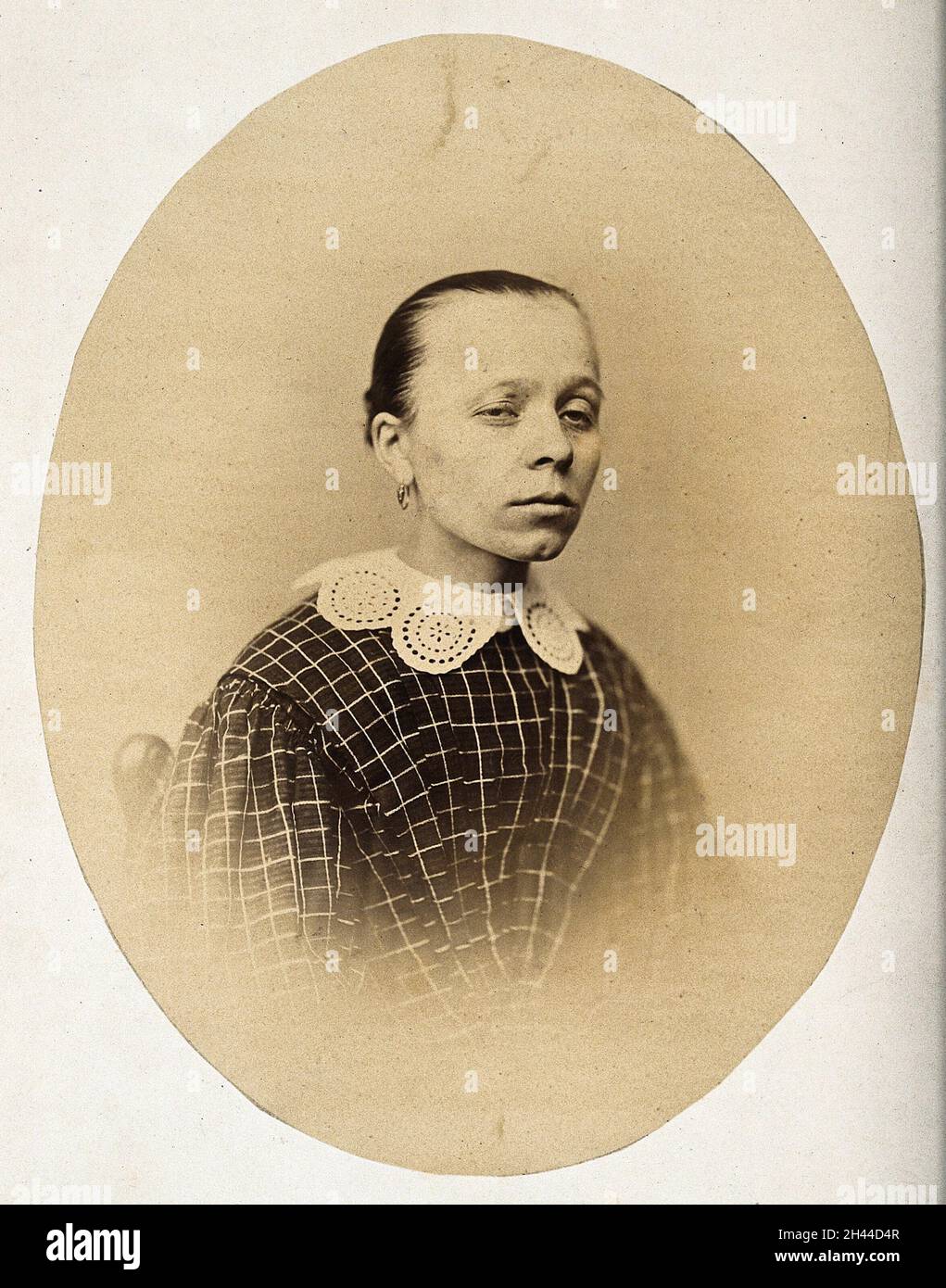 Une femme, la tête et les épaules, vue de l'avant; ses paupières sont inégales.Photographie de L. Haase après H.W.Berend, 1863. Banque D'Images