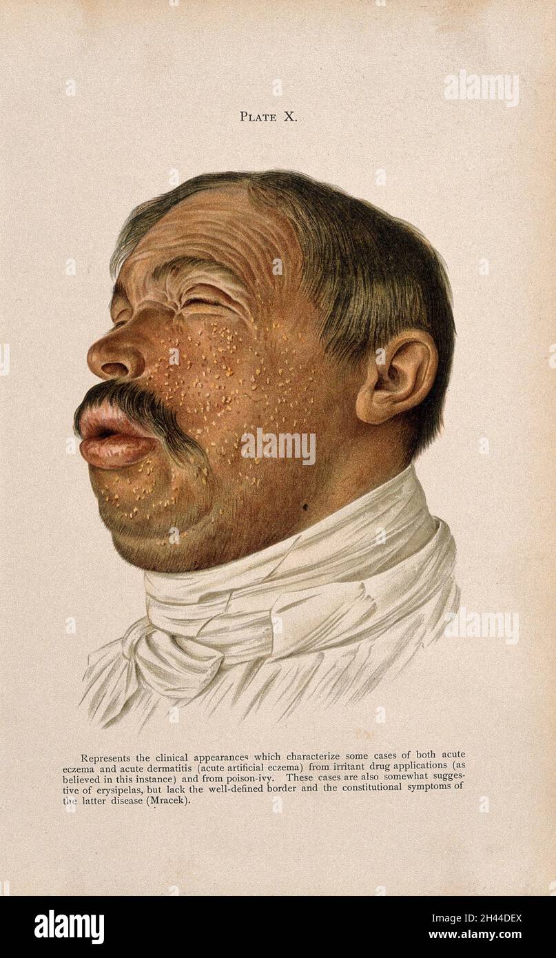 Le visage d'un homme souffrant d'eczéma aigu et de dermatite, causée par des applications de drogues irritantes et de l'ivie de poison.Lithographie de couleur après Mracek (?), ca.1905. Banque D'Images