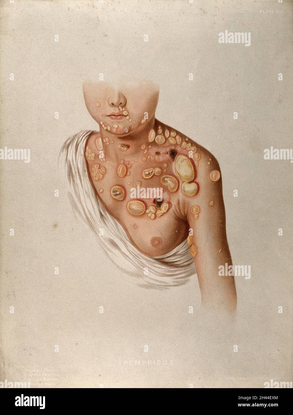 Peau malade et grandes cloques sur la poitrine, le cou, les épaules et le visage d'un enfant souffrant de pemphigus.Chromolithographe par E. Burgess, 1850/1880? Banque D'Images Peau malade et grandes cloques sur la poitrine, le cou, les épaules et le visage d'un enfant souffrant de pemphigus.Chromolithographe par E. Burgess, 1850/1880? Banque D'Images
