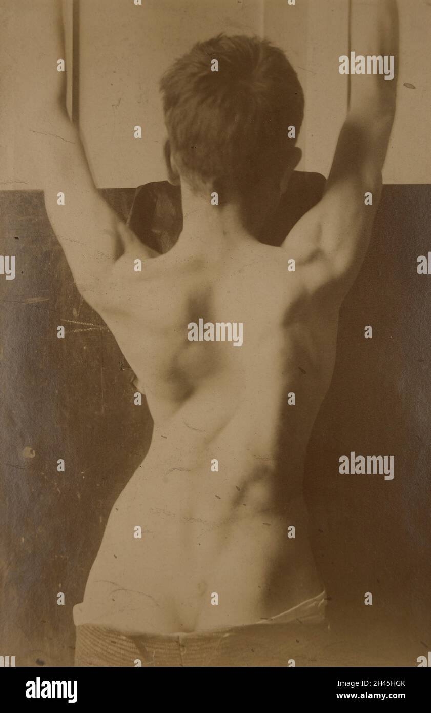 Dos d'un jeune montrant la chute dans la poitrine après empyema Banque D'Images