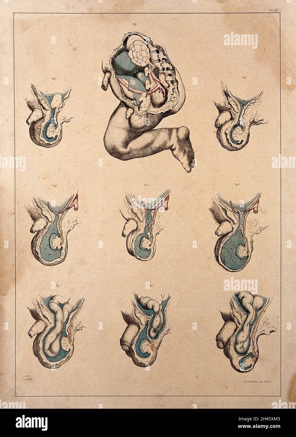 Hernies congénitales et infantiles : neuf chiffres.Lithographie colorée par J. Maclise, 1851. Banque D'Images