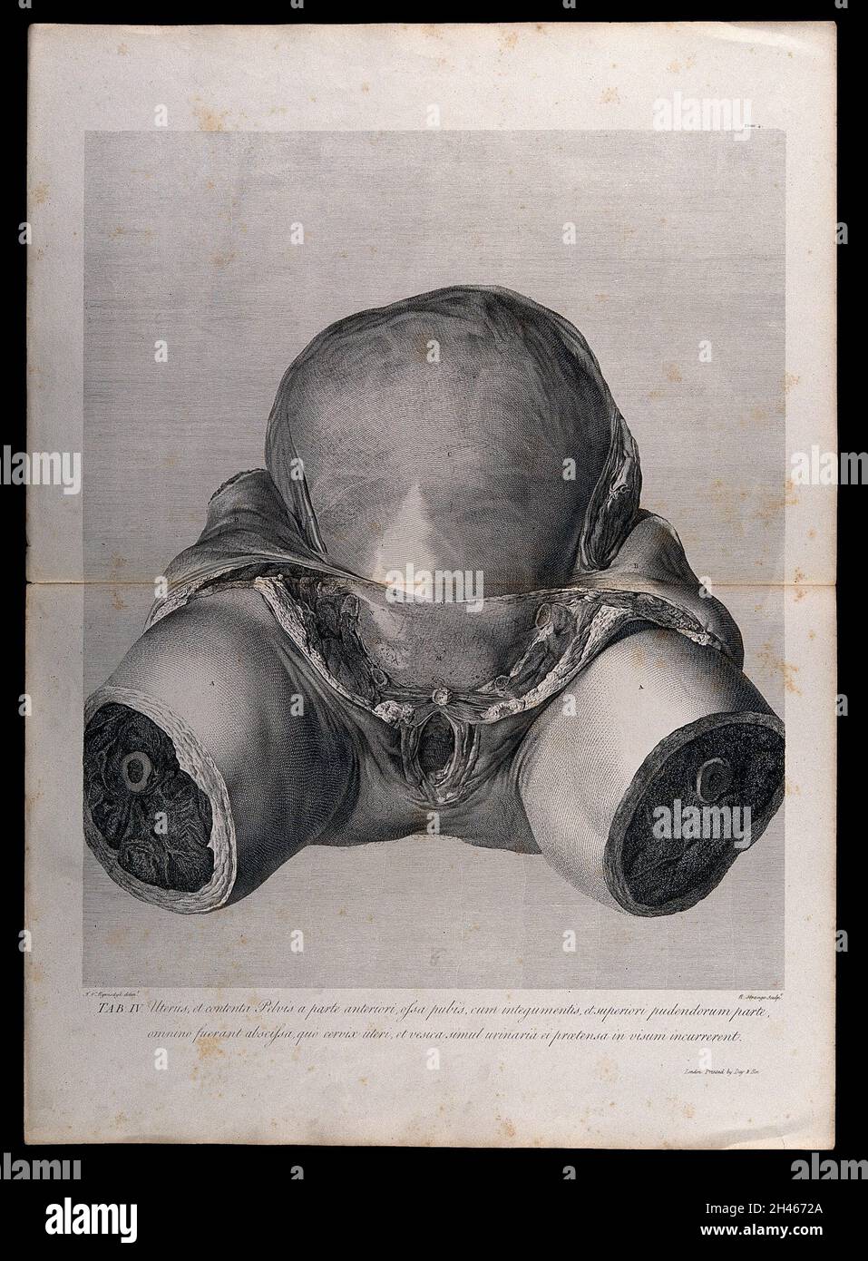 Vue avant de l'utérus enceinte et de la région pelvienne, montrant la peau pelée pour révéler l'utérus gonflé.Gravure de copperplate par R. Strange après I.V.Rymsdyk, 1774, réimprimé 1851. Banque D'Images