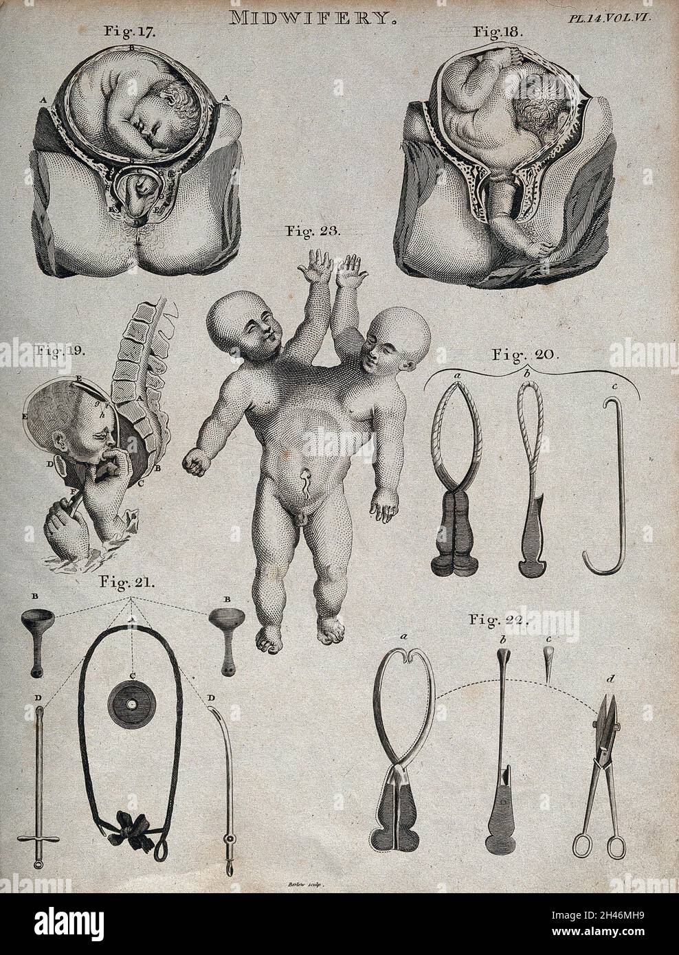 Sept diagrammes illustrant des naissances difficiles, des instruments obstétricaux et un jumeau conjoint.Décapage par Barlow. Banque D'Images