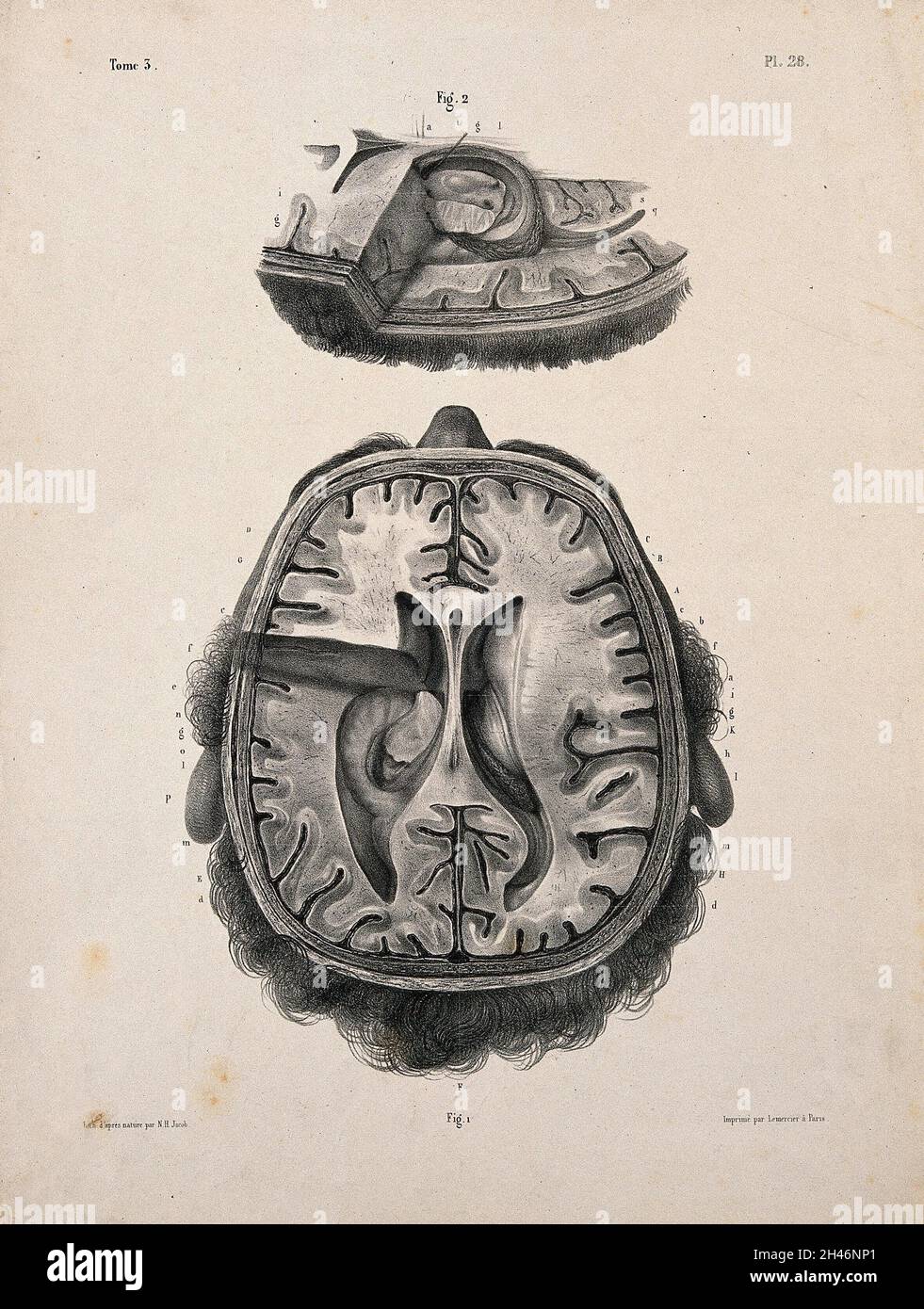 Le cerveau : deux figures d'une section à travers la tête et le cerveau, montrant les ventricules latéraux et le troisième ventricule.Lithographie par N.H Jacob, 1831/1854. Banque D'Images