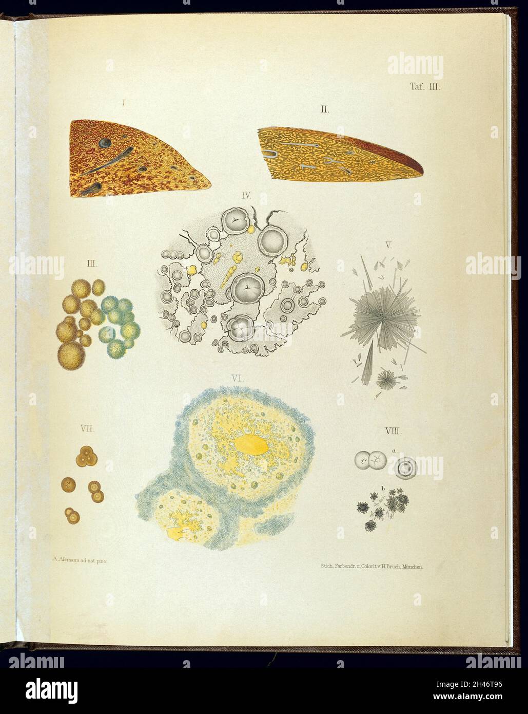 Atrophie aiguë du foie.Leucine et tyrosine des sécrétions. Banque D'Images