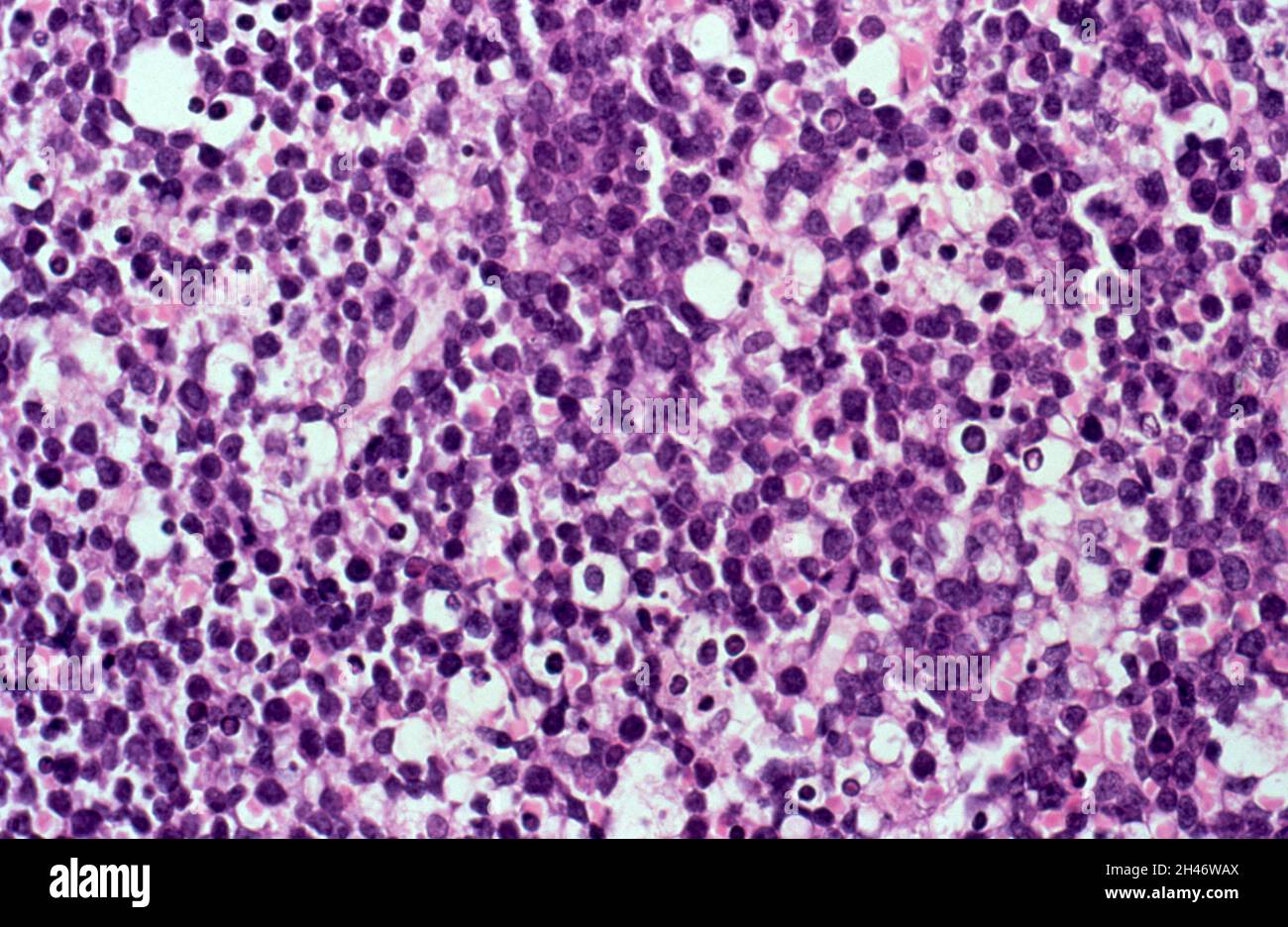 Lymphome non hodgkinien avec SIDA : moelle osseuse Banque D'Images