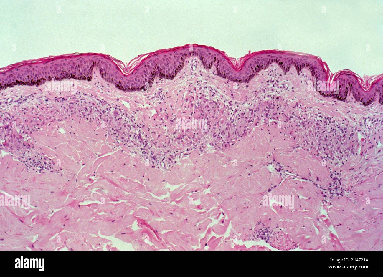 Lèpre : peau Banque D'Images