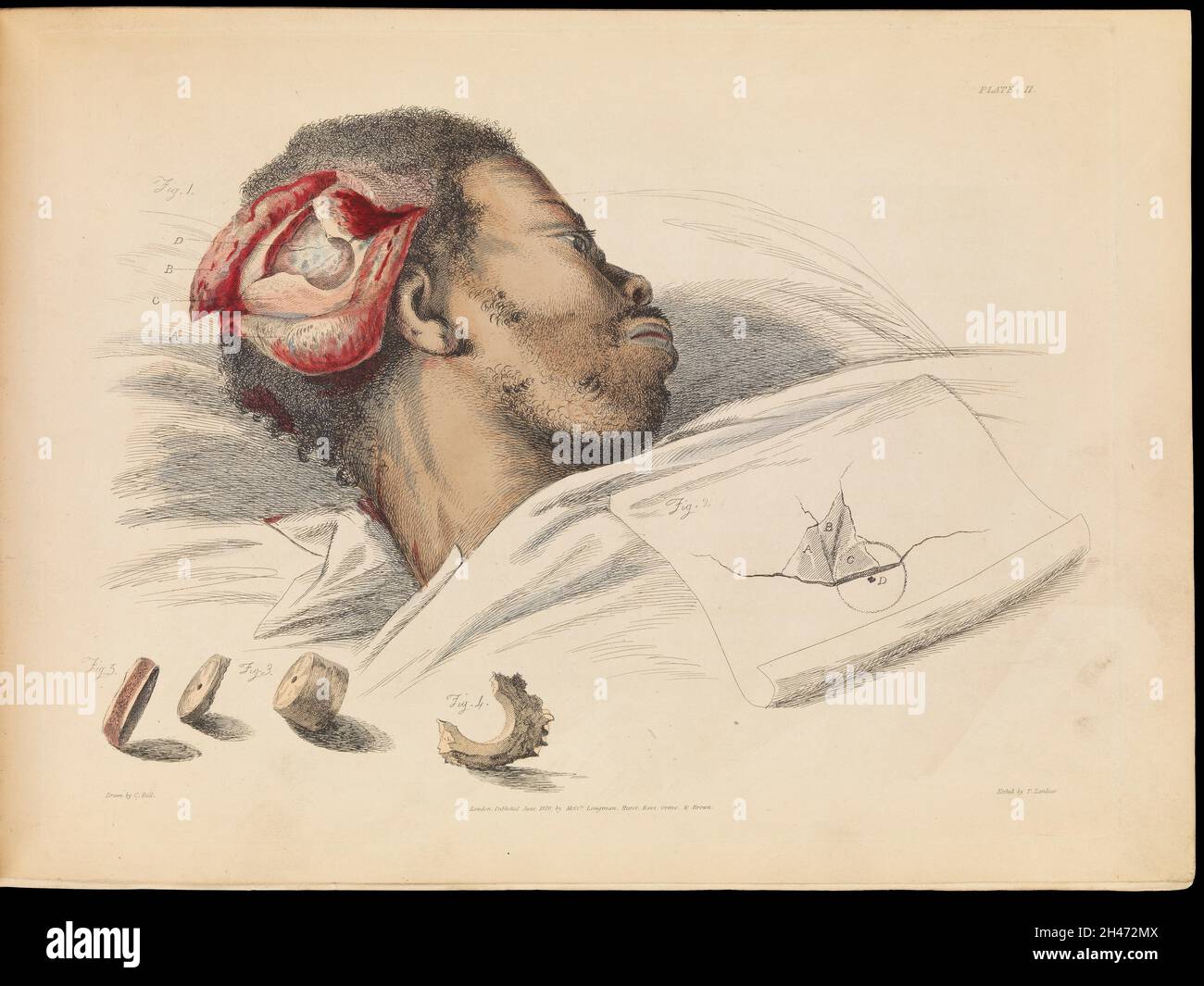 Plaque II, illustration de la tréphination.Sir Charles Bell Banque D'Images